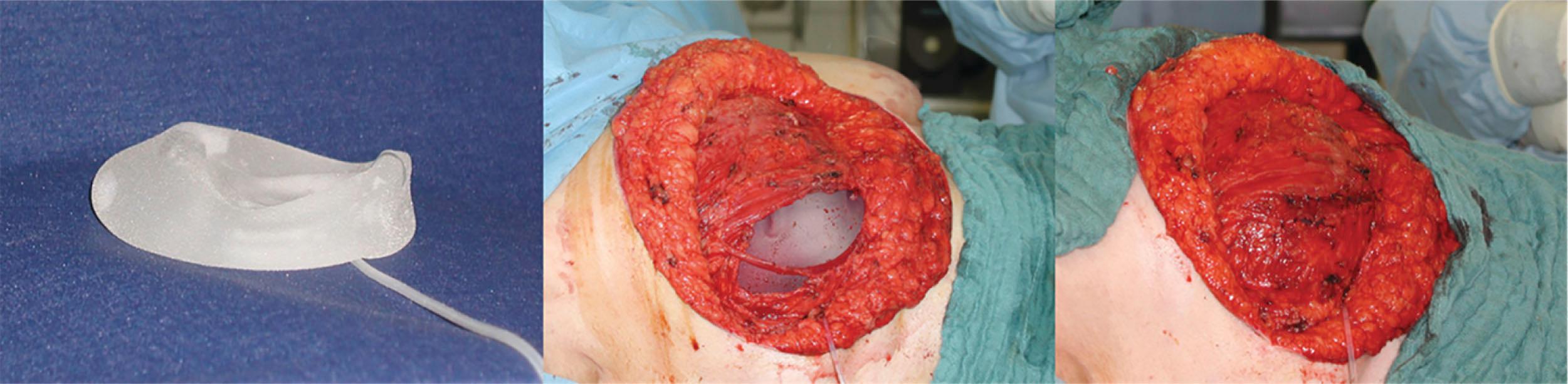 Figure 26.1, (Left) Becker expander unfilled; (middle) Becker expander in situ after creating a subpectoral pocket; (right) intraoperative expansion of expander after closing of muscular pocket.