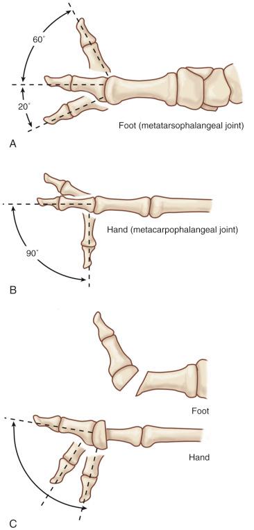 Figure 54.4, (A,B) The metatarsophalangeal joint of the great toe has a wide range of motion in extension; on the contrary, the metacarpophalangeal joint of the thumb moves mostly in flexion. (C) Oblique osteotomy of the first metatarsal avoids hyperextension of the metatarsophalangeal joint of the transferred great toe.