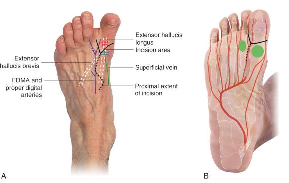 Figure 54.5, (A) A V-shaped skin flap is marked on the dorsal surface. (B) A V-shaped flap on the plantar surface. The incision is extended between the first and second metatarsal heads, avoiding scar formation on the weightbearing areas is marked. FDMA, first dorsal metatarsal artery.