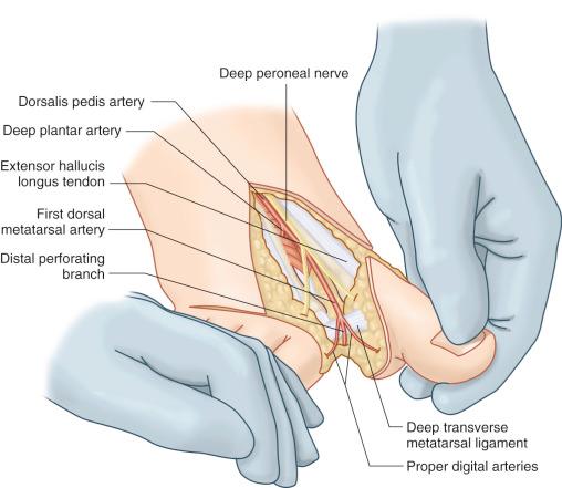 Figure 54.6, Retrograde dissection from the first web space allows direct visualization of the main vascular pattern and anatomic variations. Once the FDMA and the distal perforating branch to the plantar system are exposed, one can choose to proceed with dorsal or plantar dissection depending on the vessel's diameter. Dorsal dissection is easier and straightforward and should be considered as first choice whenever possible.