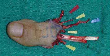 Figure 54.7, Great toe flap harvested. One centimeter of the first phalanx is preserved in order to maintain the attachment of the plantar aponeurosis and intrinsic muscles in the foot. Red arrow, FDMA; blue arrow, superficial dorsal vein; yellow arrows, plantar digital nerves and deep peroneal nerve.