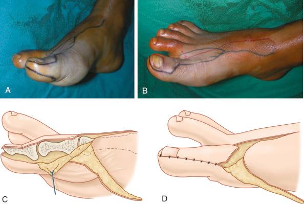 Figure 54.8, Trimmed toe transfer. (A,B) Circumferential measurements of the intact thumb are reproduced on the great toe. The resulting medial flap represents the excess tissue. (C) A medial joint flap composed of the periosteum, the medial collateral ligament, and the capsule is elevated plantarly and a longitudinal osteotomy resects part of the bone. (D) The joint and collateral ligament are reconstructed with appropriate tension, so as to avoid instability in the interphalangeal joint.