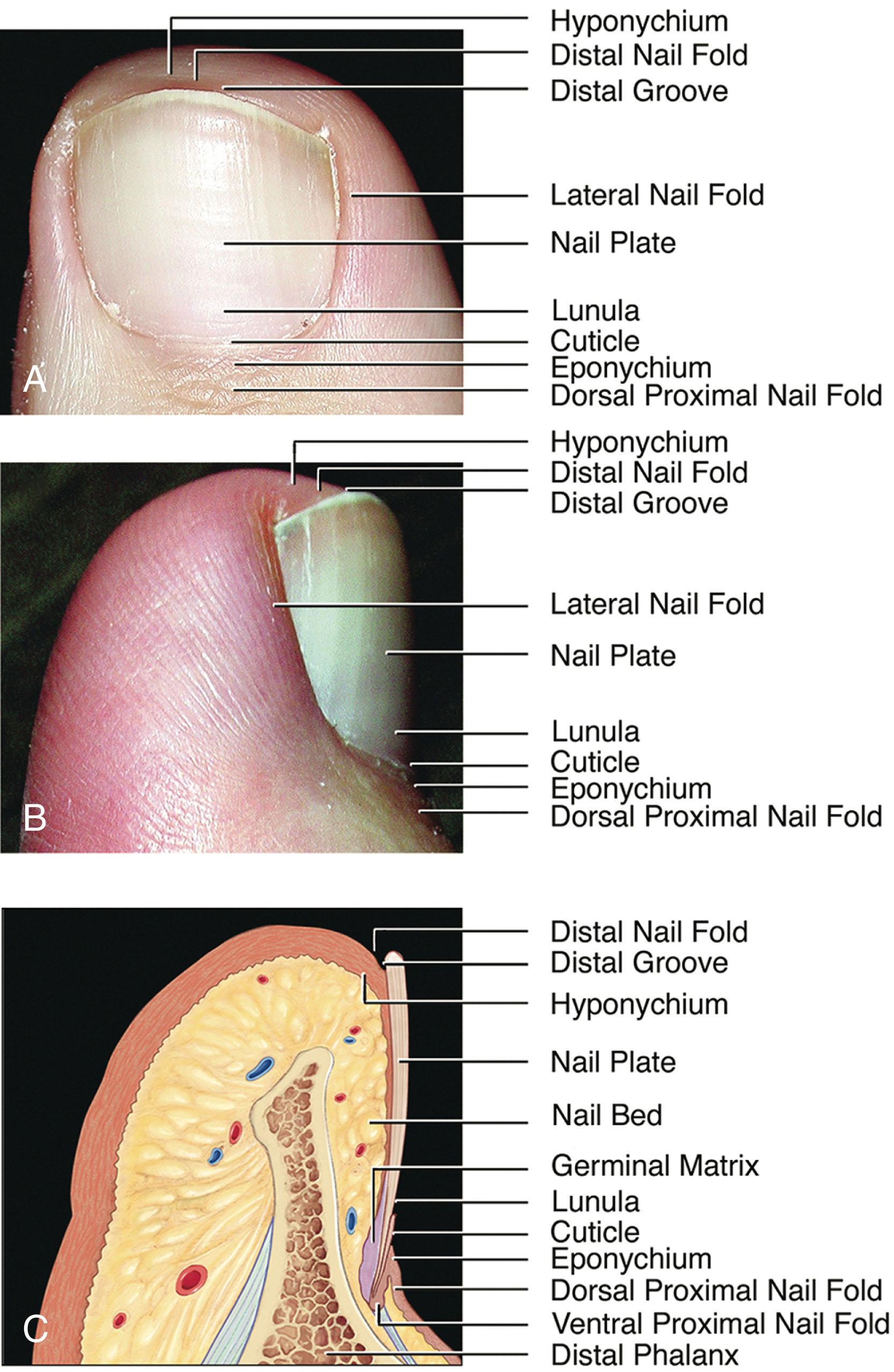 Fig. 14-1, A , anteroposterior (top) and B , lateral (middle) photographs of a toenail and C , a sagittal–lateral cross-sectional drawing (bottom) showing the various anatomic parts of the toenail unit.