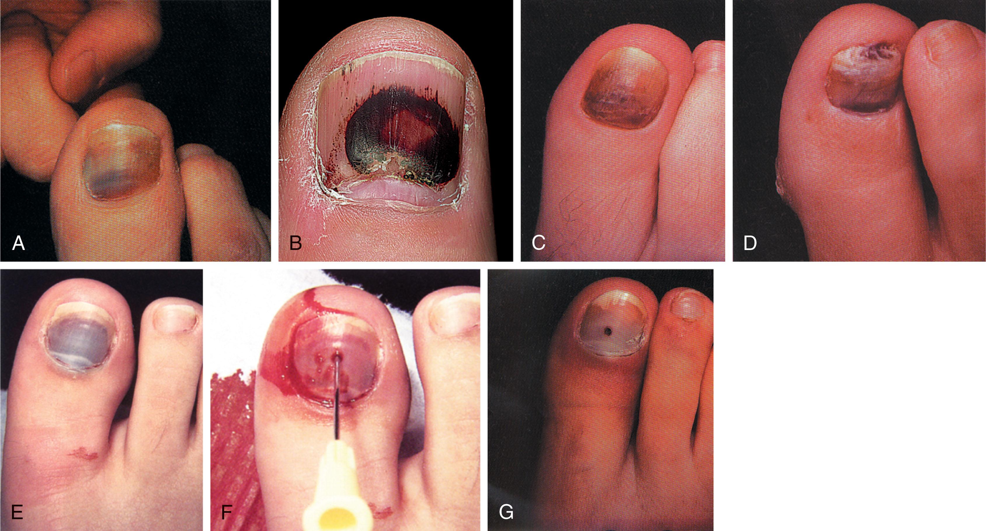 Fig. 14-12, Subungual hematoma (subacute and acute). A , Typical subacute appearance of subungual hemorrhage after direct trauma to toenail. B , When there is considerable pain or swelling under the nail after hematoma formation, the hematoma may be released. With time, the hematoma evolves, and the subungual blood turns brown or black. This may take months to resolve. Melanoma can have a similar appearance, and the history is important. C , Accumulation of blood beneath the nail after trauma. The staining will persist until the nail grows out. D , Subacute appearance of hemorrhage with accumulation of debris beneath the nail. E , Acute subungual hematoma. F , A small hole created in the nail allows blood to drain, but the procedure must be done soon after injury because coagulated blood cannot be drained. G , After removal of the needle.