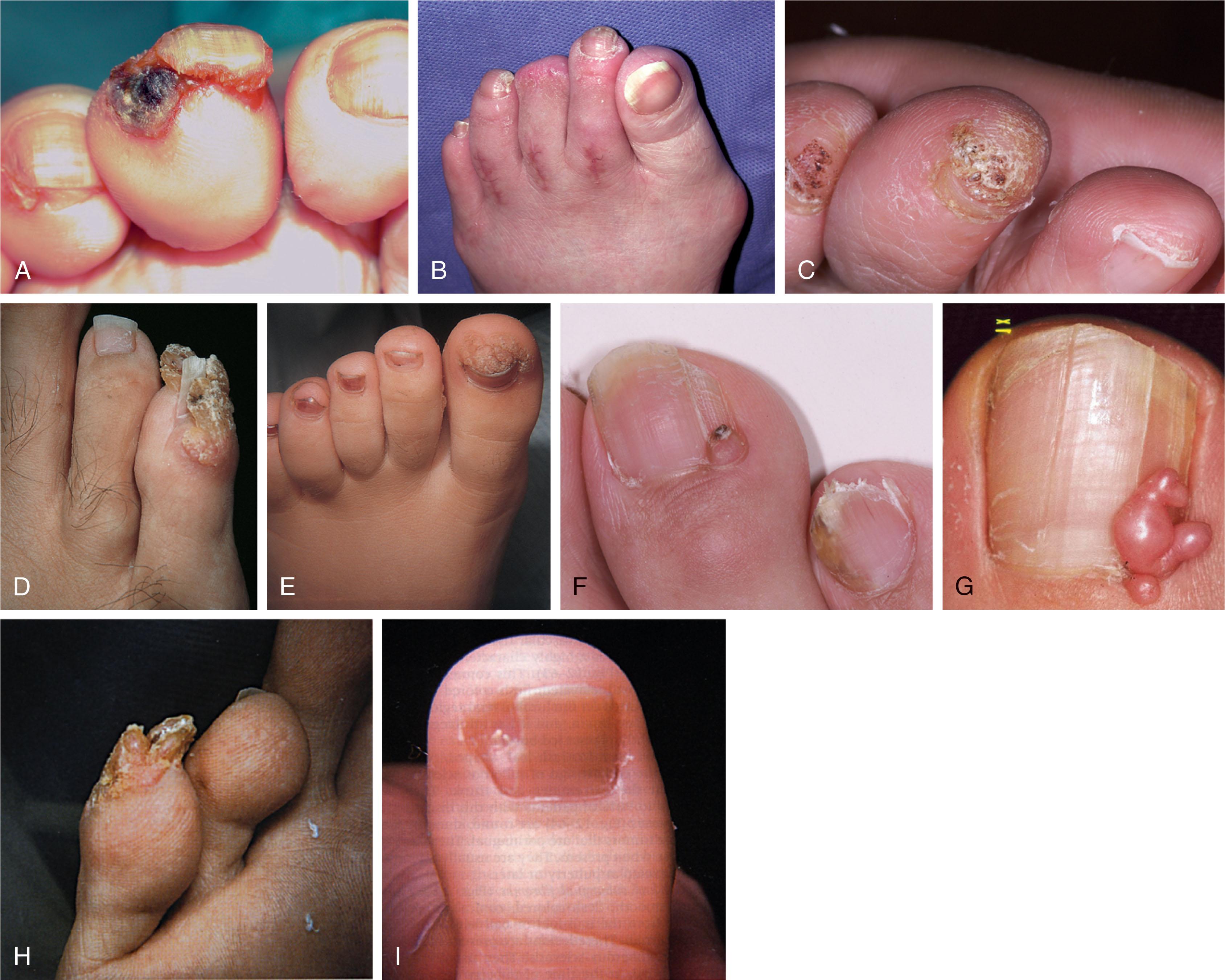 Fig. 14-13, A , Subungual wart (verruca) on the third toe was refractory to topical treatments. B , Treatment of verruca on the third toe was by amputation at the distal interphalangeal joint. C , Verrucae on multiple toes. D , Filiform wart with finger-like projections around the fifth toenail. E , Subungual wart causes distortion of the hallux nailplate. F , Angiofibroma. This may be the first evidence of tuberous sclerosis or ectodermal dysplasia. G , Periungual fibroma producing a longitudinal deformity in the nail plate. H , Tuberous sclerosis. Periungual fibromas are present on the tip of the fifth toe in a patient with tuberous sclerosis. I , Subungual fibroma on the lateral edge of the nail plate in a patient with tuberous sclerosis.