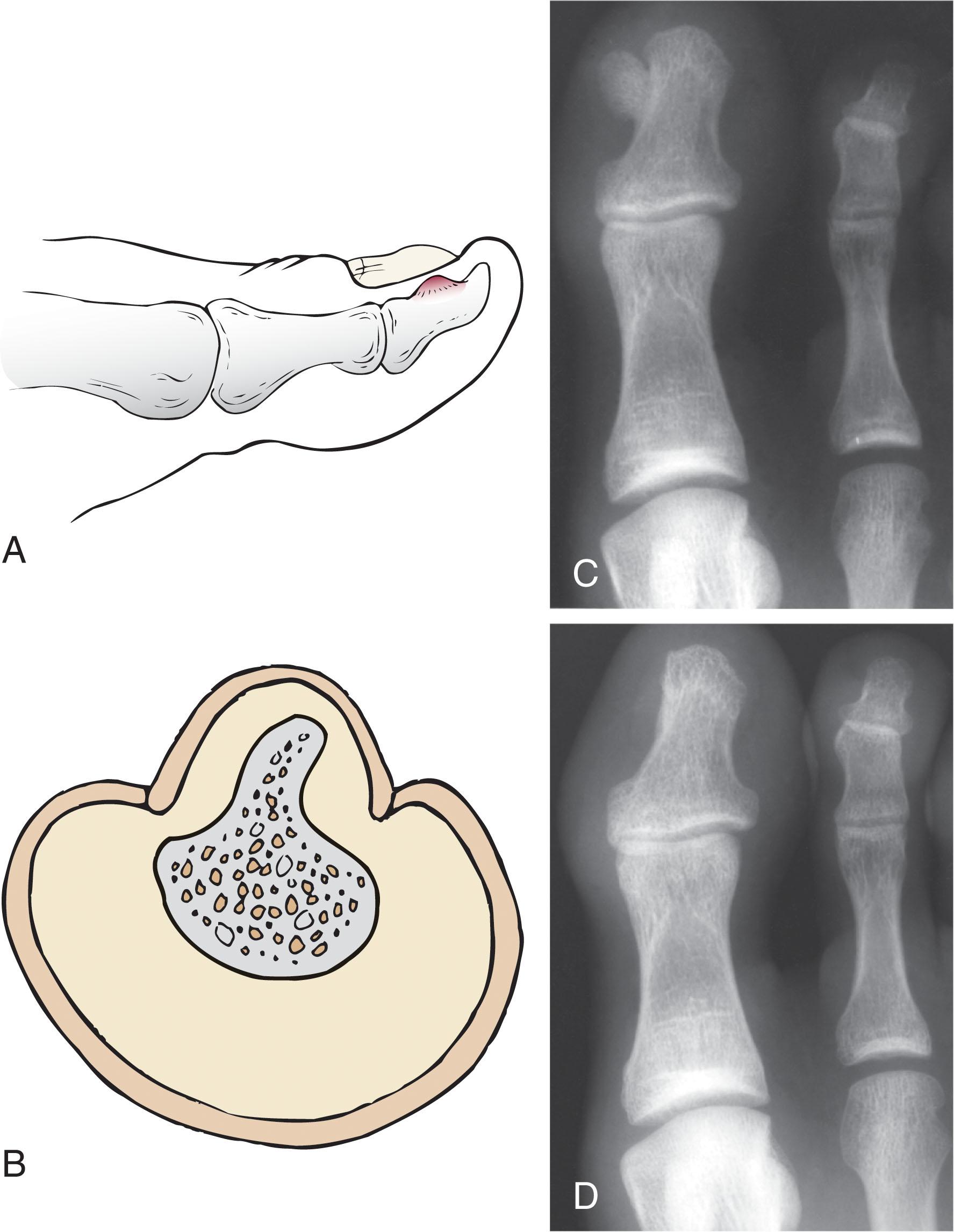 Fig. 14-15, A , Lateral view of toe shows the effect of subungual exostosis on the configuration of the nail plate. B , Cross section of distal phalanx shows deformation of the nail plate by subungual exostosis. C , Radiograph shows subungual exostosis before excision. D , Radiograph after excision of exostosis.