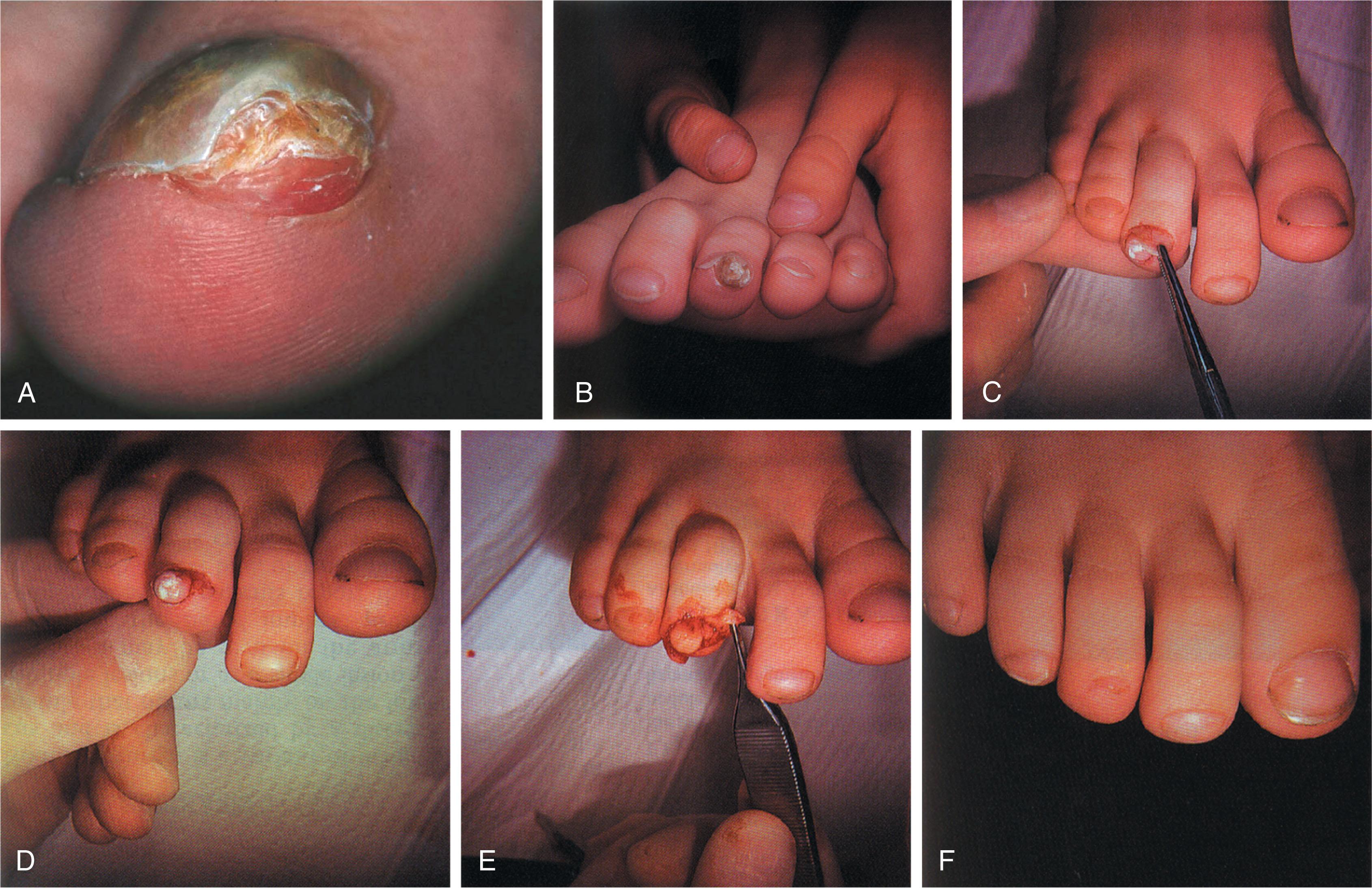 Fig. 14-16, A , Subungual exoxtosis elevating the nail plate. B , Osteochondroma in 9-year-old with painful lesion of third toe previously diagnosed as a subungual wart. C , Surgical procedure to treat above lesion involves avulsion of the toenail. D , Exposure shows the osteochondroma and the cartilage cap. E , The lesion is surgically dissected and removed. F , Six weeks after excision, showing the beginning growth of a new toenail.