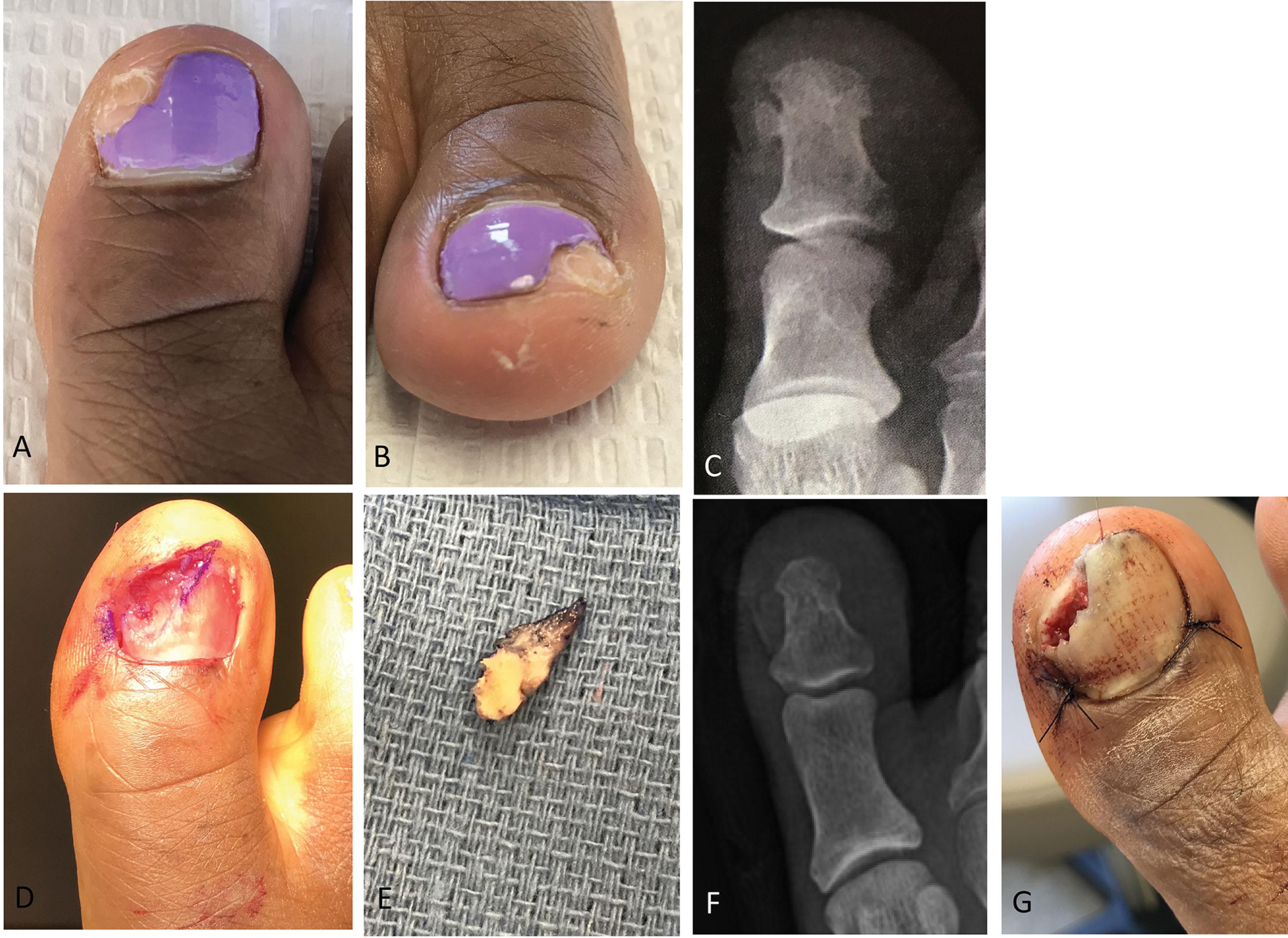 Fig. 14-18, Technique for surgical excision of subungual exostosis with healing by secondary intention. A and B , Clinical appearance of a painful lesion affecting the dorsomedial right hallux nail plate in 40-year-old female. C , Oblique X-ray demonstrating the dorsomedial location of the exostosis. D and E , The toenail is completely avulsed to expose the nail bed and underlying exostosis. Converging semi-elliptical incisions are performed down to bone and the ellipse of nail bed is removed from the field to expose the bony lesion. F , Exostosis is excised with wide margins. G , The wound is packed with collagen substitute, and the nail plate is re-affixed and placed back under the proximal fold to act as an initial scaffold for the new nail plate and to protect the nail bed.