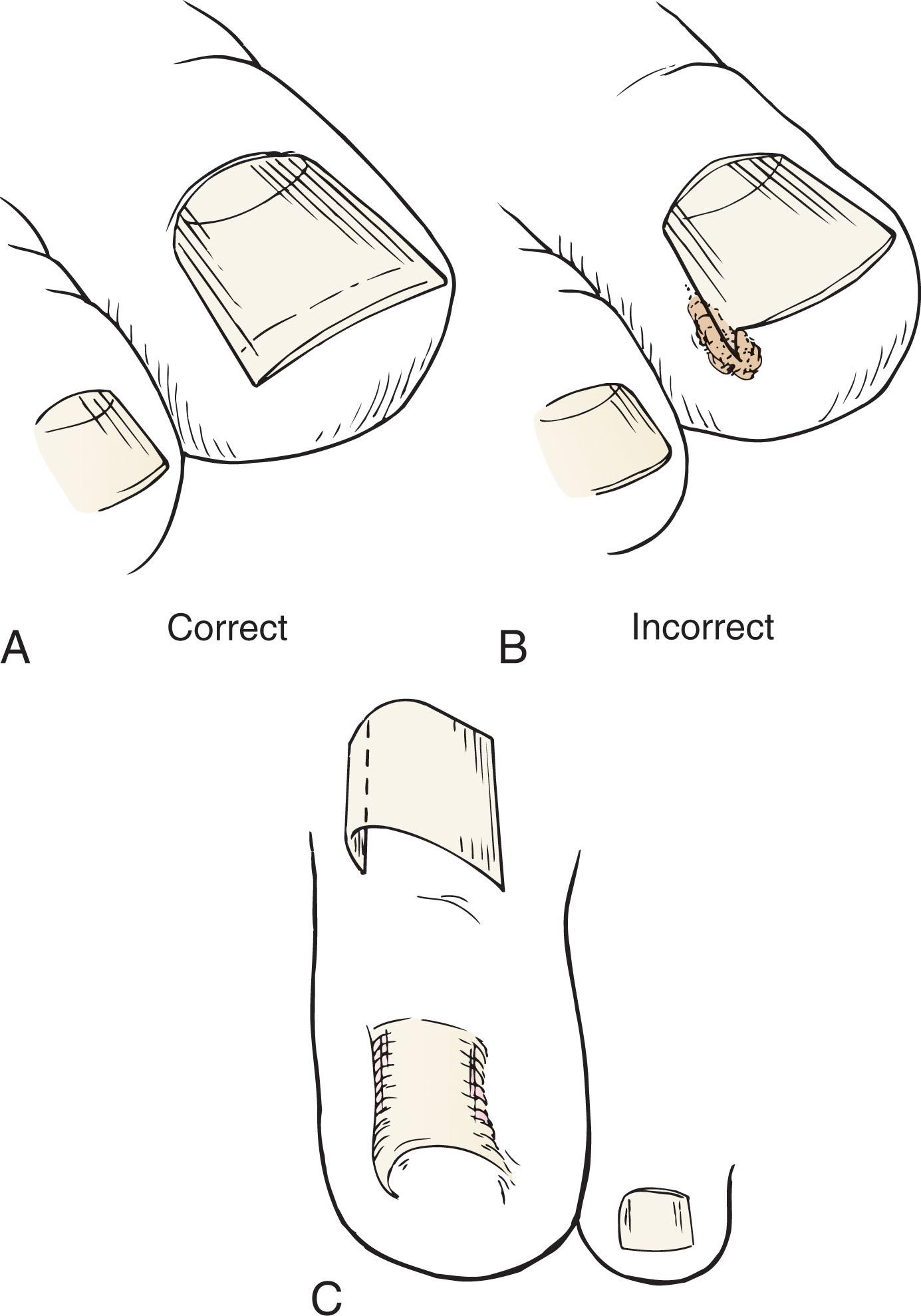 Fig. 14-22, A , Correct nail trimming prevents in-growth into the adjacent nail fold. B , Incorrect trimming can lead to a fishhook-shaped spur in the lateral nail fold, with subsequent infection. C , Abnormal incurving of the medial border can predispose to infection.