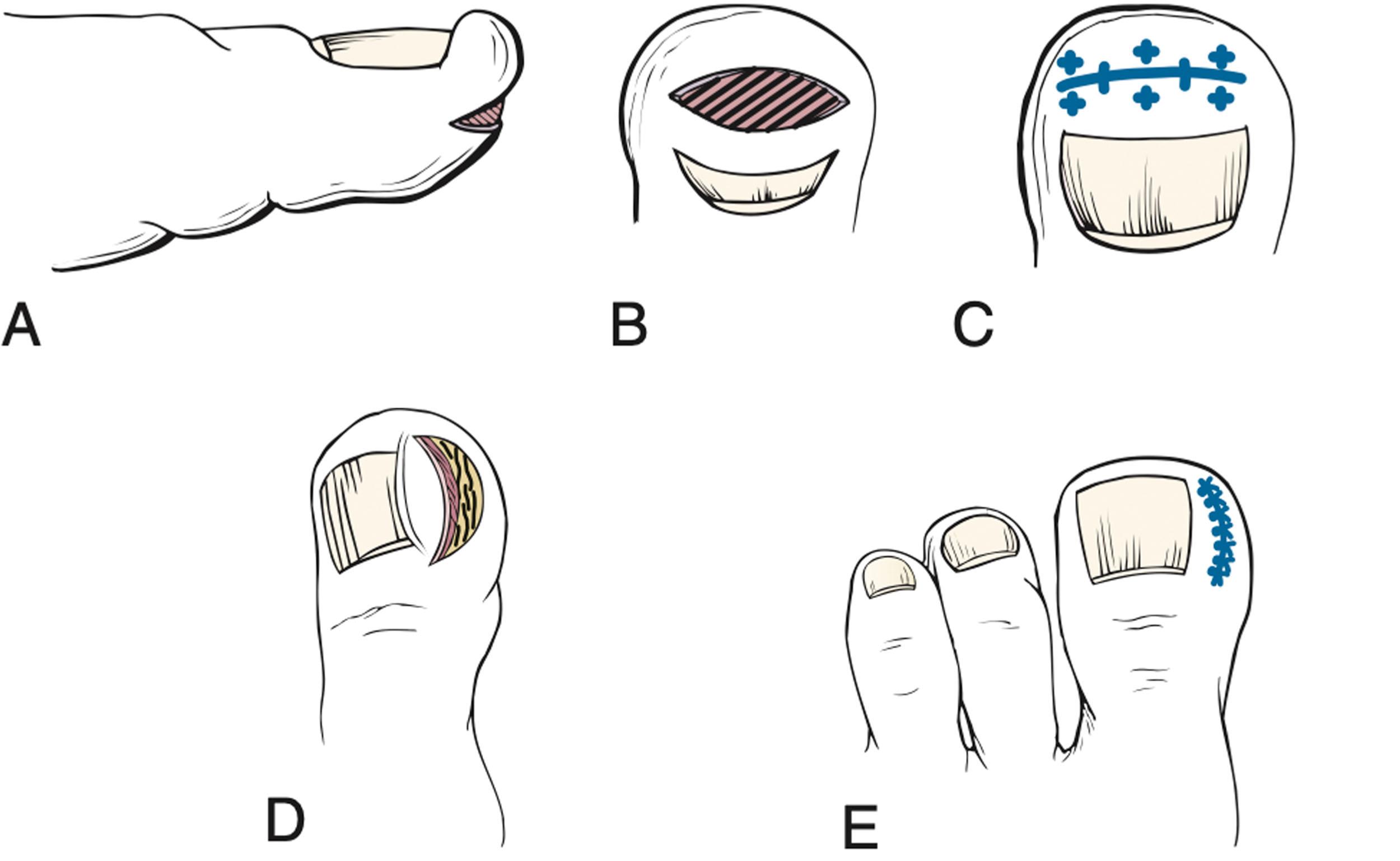 Fig. 14-24, Ingrown toenail. A – C , Elliptic incision is used to resect redundant skin and soft tissue of the distal tuft. Closure of the elliptic incision tends to reduce distal impingement against the advancing distal nail plate. D and E , Elliptical incision used to resect redundant skin and soft tissue of the lateral fold.