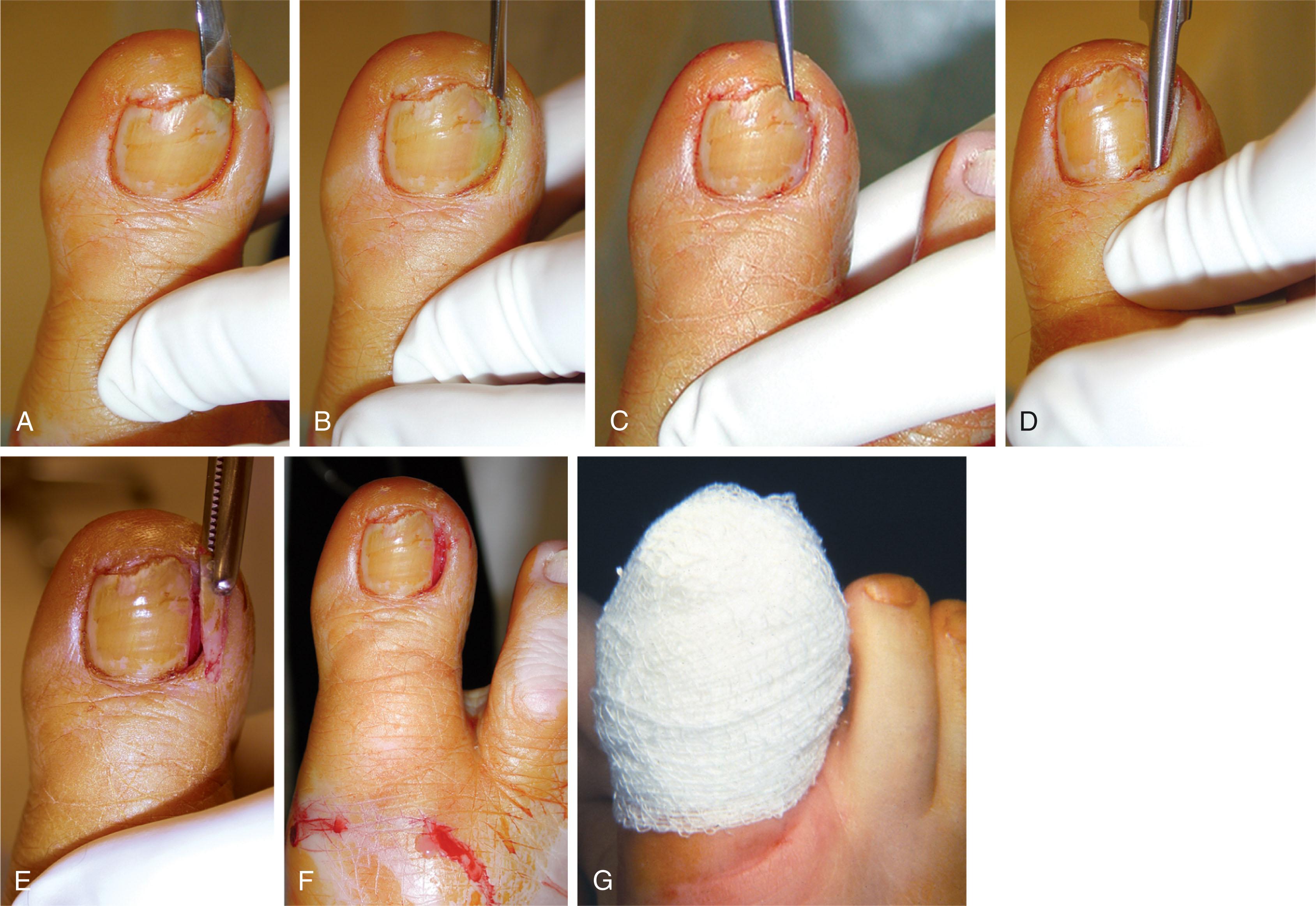 Fig. 14-25, Treatment of onychocryptosis. A and B , The outer edge of the nail plate is elevated proximal to the cuticle. C and D , The nail border is incised longitudinally with nail splitter, scissors, or English anvil. E and F , A longitudinal portion of the nail is removed with hemostat to relieve symptoms of acute infection. G , Gauze dressing is applied after the toenail procedure.