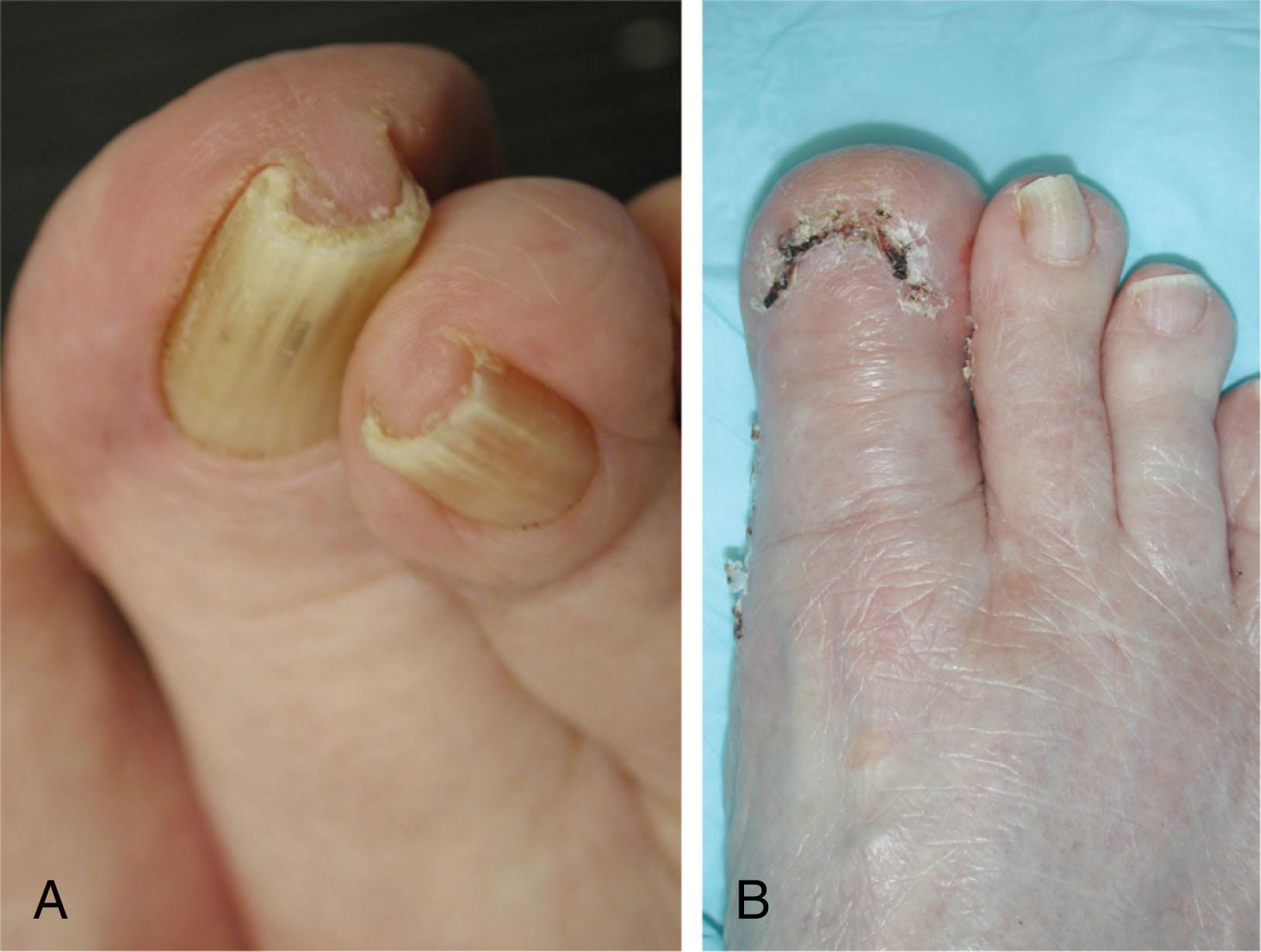 Fig. 14-27, Terminal Syme amputation. A , Clinical example of nail incurvature in an elderly patient. Because of the chronicity of symptoms, the patient opted for a terminal Syme amputation involving complete excision of the nail bed/matrix and removal of the distal portion of the distal phalanx which allows for closure. B , Three weeks postoperatively.