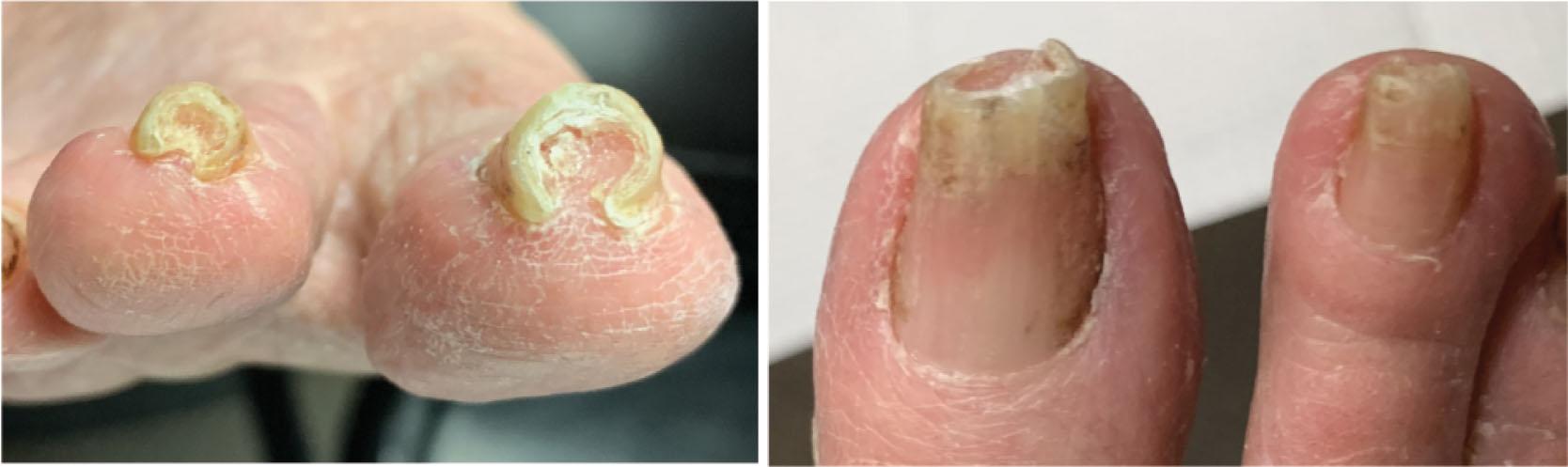 Fig. 14-28, Pincer nail deformity can be seen in the hallux and second nail plate. The nail plate is severely turned in on both sides forming a near complete circle.