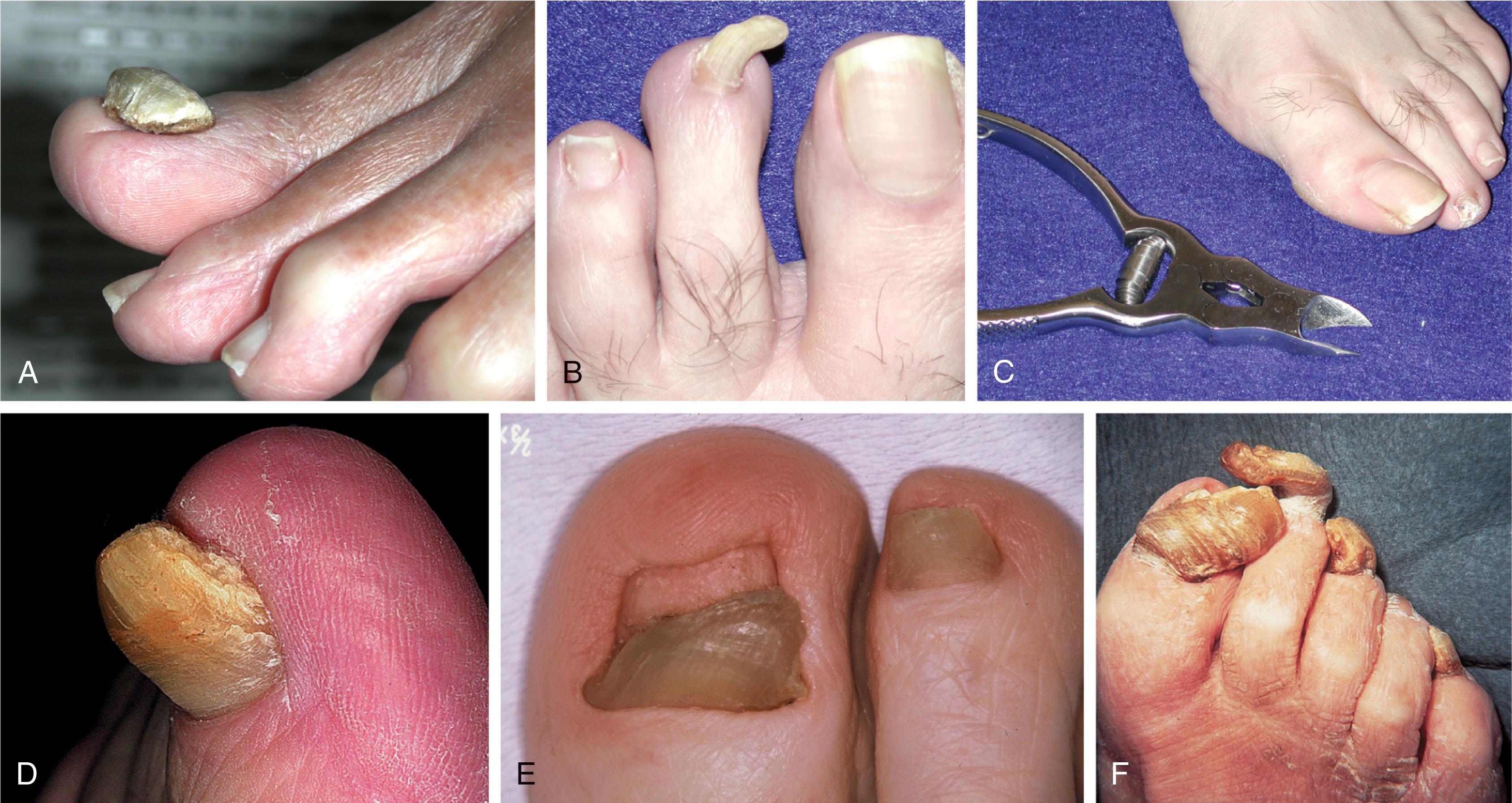 Fig. 14-29, Onychogryphosis. A and B , With onychogryphosis, nails may become grossly thickened. C , With the use of a special nail cutter, these nails can be trimmed in the office. D , Thickened and elevated nail. E , Congenital deformity of the great toenail. F , Ram’s horn toenail deformity from chronic infection and lack of proper care.