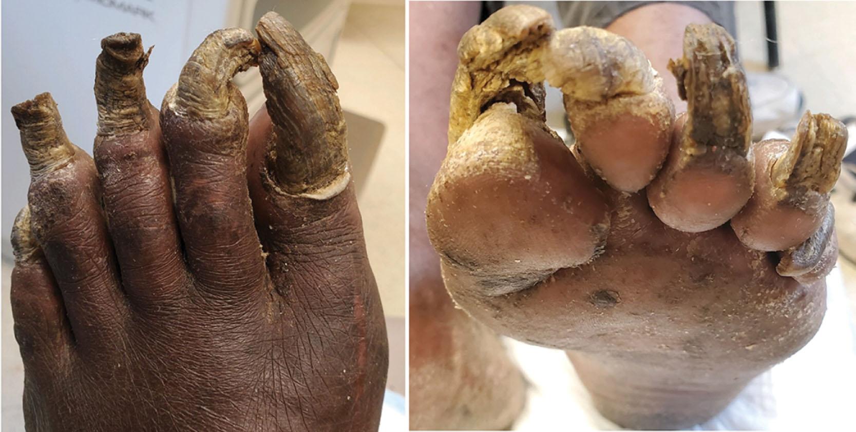 Fig. 14-30, Onychogryphosis (severe). This is the result of repeated trauma to the nail matrix and poor hygiene. Nail sampling failed to identify fungal organisms.