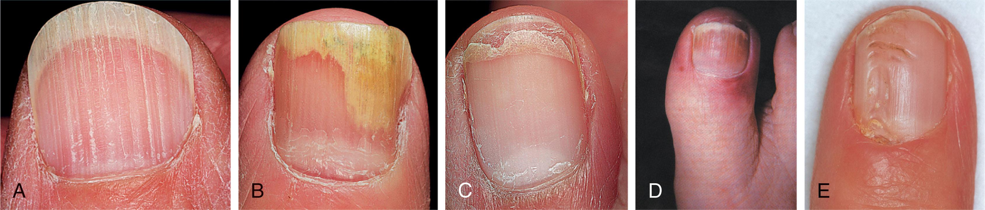 Fig. 14-3, A , Longitudinal ridging of the nail is a change of aging. It can also be a normal variant. B , Onycholysis is a separation of the nail plate from the nail bed. It can occur because of repeated pressure on the distal nail plate with tight or short shoes that tend to lift the end of the nail. C , Onychoschizia. Distal nail fissuring or splitting occurs with dryness, and layers may peal away. D , Inadequate circulation may lead to rubor around the nail and thickening of the nail along with ischemic pain. E , Pterygium developed after myxoid cyst, leaving a longitudinal groove in the nail.