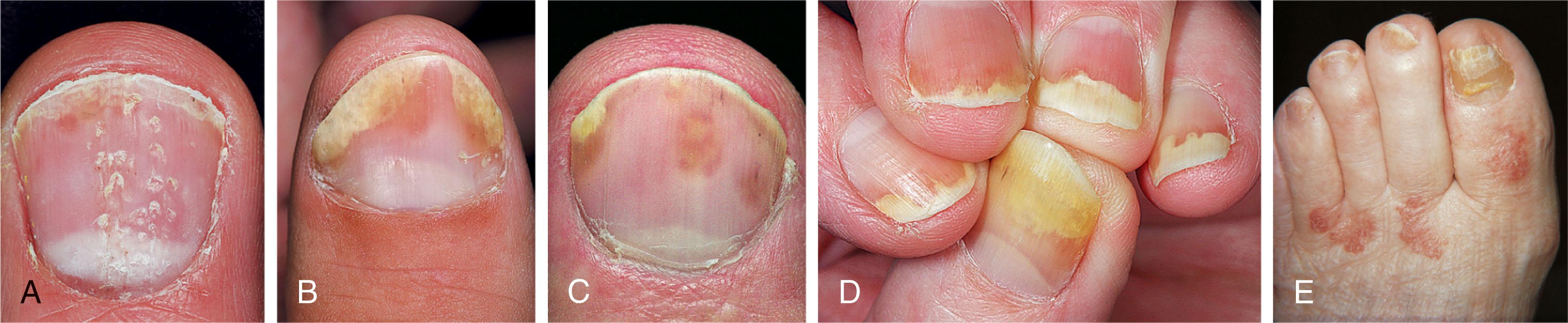 Fig. 14-4, Psoriatic toenail dystrophy. The nail is thick, discolored, and distorted because of psoriasis of the nail matrix. The symmetry is striking, and the skin may also be involved. A , Psoriatic pits can occur in a linear fashion and may occur along longitudinal lines. B , Psoriasis of the nail can produce separation of the nail from the nail bed and an accumulation of subungual debris. The accumulation of serum beneath the nail may form what is called an oil spot . C , Oil spot lesions are brown stains seen on the nail. D , Separation of the nail plate and accumulation of subungual debris is common. These changes can also occur after nail trauma and can occur with multiple nail involvement. E , Psoriatic involvement of both the nails and skin with several plaques on the dorsal surface.