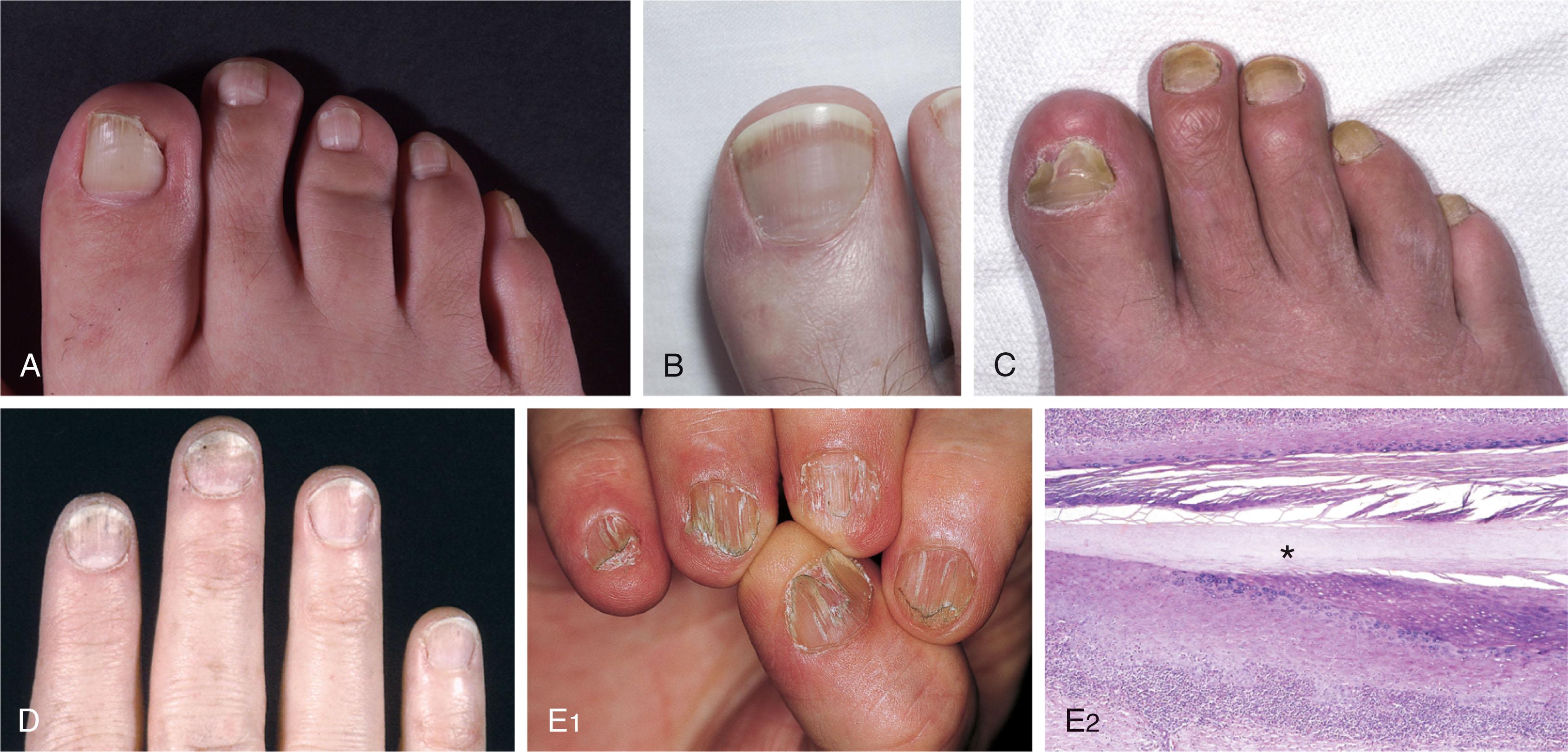 Fig. 14-5, Various nail deformities. A , Beau lines. Horizontal troughs are apparent midway up the nail about 3 months after an illness, trauma, or in this case, chemotherapeutic treatment. B , Terry nail. Diabetes and liver disease can produce a pinkish band located at the distal edge of the nail plate. C , Yellow nail syndrome. The nails are discolored yellow and are often curved, particularly across the horizontal axis. D , Splinter hemorrhages or marks of tiny telangiectasia. Tiny subungual vessels or hemmorages occur; these are associated with a clinical case of scurvy. E , Nail deformity with thinning and longitudinal ridging and fissuring associated with lichen planus.