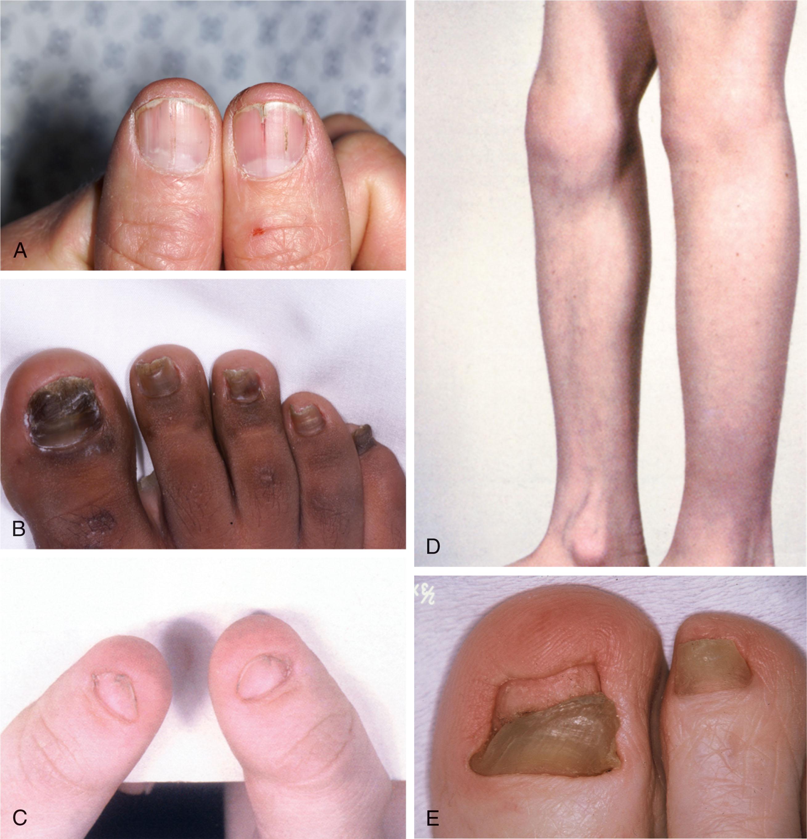 Fig. 14-6, A , With Darier disease, also see distal fissuring with thin and friable nails and alternating red-and-white lines. B , Chronic nail changes with Darier disease of the nail, which include longitudinal ridges, subungual thickening, and notching at the distal margins. C , Pachyonychia congenita. Within the first year after disease onset, the nails become thickened, particularly at the tip, and wedge shaped. D , Nail-patella syndrome. The thumbnails and hallux toenails are either absent or partially formed. Other nails may be involved to a lesser extent. E , Longitudinal erythronychia (red lines) and notching of nail edge with Darier disease.