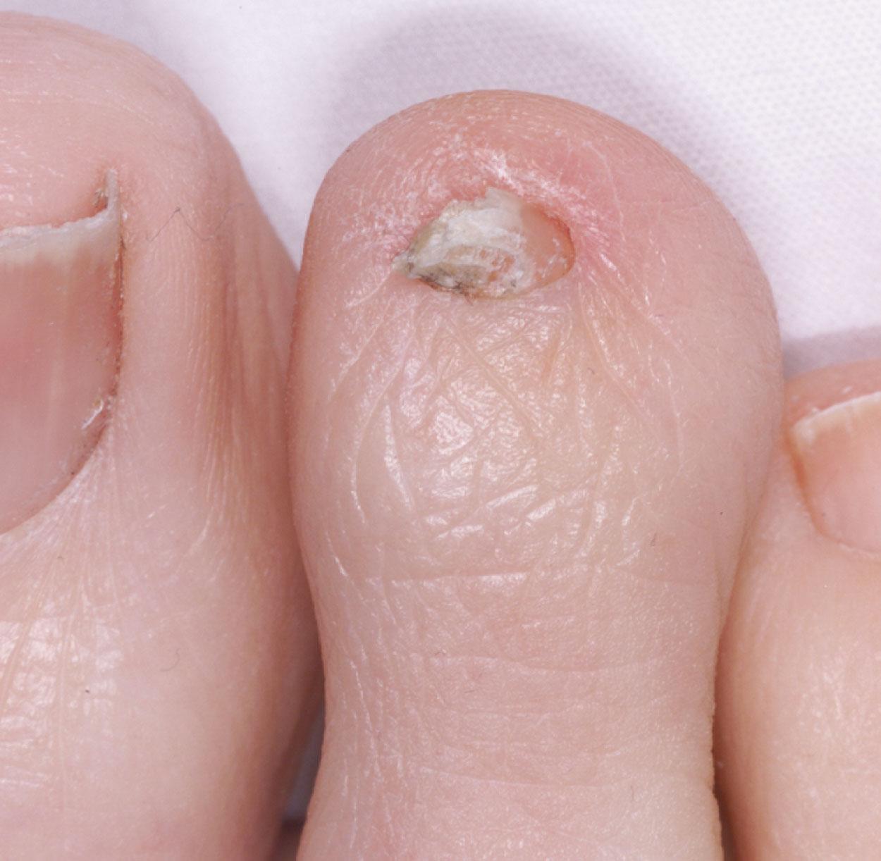 Fig. 14-7, Micronychia. Nails may be totally or partially absent as the result of a congenital defect.