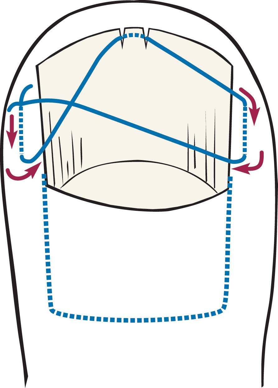 Fig. 14-8, Example of placement of absorbable transverse figure-of-eight suture to the toe.