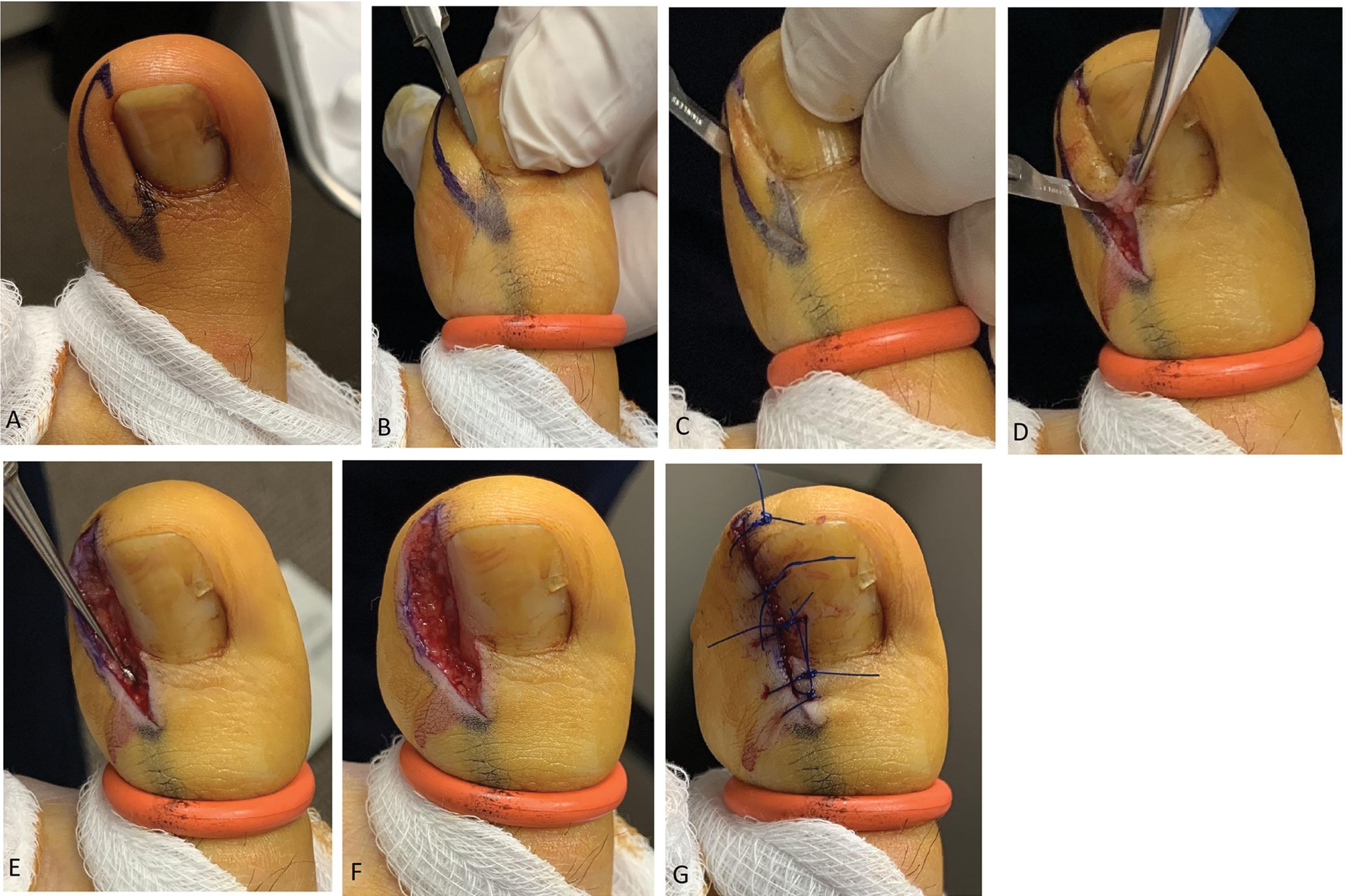 Fig. 14-9, Winograd procedure for partial onychectomy. This patient had a history of repeated lateral ingrown toenail of the left great toe and had failed prior attempts at chemical matrixectomy. A , The hypertrophied lateral nail fold and incurvated lateral nail plate can be appreciated. The planned ellipse of skin and nail plate/bed is inked out. B , With digital tourniquet applied, an English anvil (or other cutting instrument) is used to cut through the lateral nail plate and advanced proximally under the eponychium to cut the entire plate back to the germinal matrix. C , A full thickness longitudinal incision is made down to bone starting 6 mm proximal to the eponychium and advanced through the divided nail plate out to the distal tip of the toe. Another semi-elliptical full thickness incision is made to complete the resection the hypertrophied nail fold. D , The wedge of skin, nail bed/germinal matrix, and incurvated nail are then sharply excised from the underlying distal phalanx and removed en toto. E , The proximal wound is explored for any remaining germinal matrix (which will appear as glistening white) and excised with a dermal curette. F , The wound is irrigated thoroughly. G , The wound is closed with 3-0 Prolene sutures, which can be removed in 2 weeks.