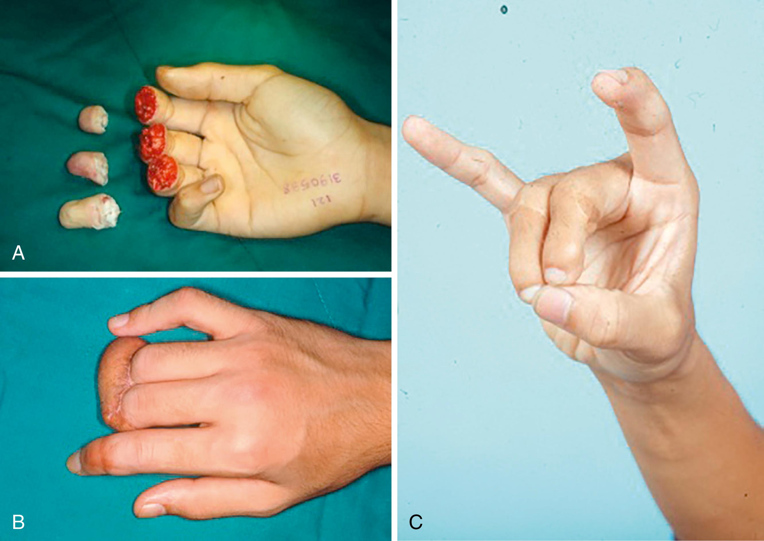 Fig. 47.1, A, Distal amputation of the index, middle, and ring fingers. B, Only the index finger was successfully replanted, and the middle and ring finger stumps were covered with a pedicled groin flap after debridement and preservation of the fingers’ skeleton, tendons, and neurovascular bundle length. C, Final result showing pinch function after reconstruction involving bilateral partial second-toe simultaneous transplantation.