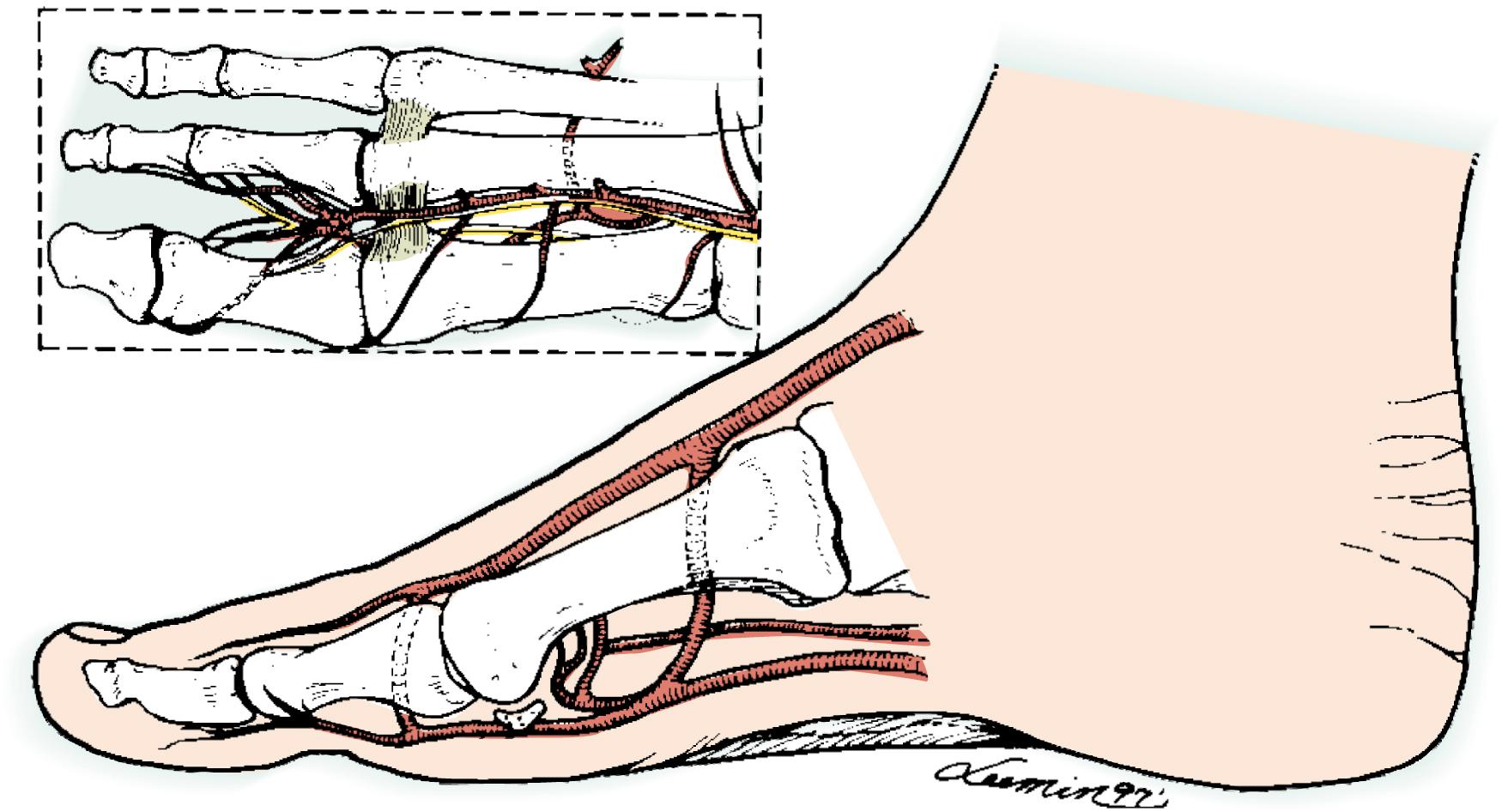 Fig. 47.11, Anatomic relationship between the first dorsal metatarsal artery over the intermetatarsal ligament and the first plantar metatarsal artery. Communicating branches are present in the web space distally and in the base between the first and second metatarsal bones (also known as the deep perforator or proximal communicating artery).