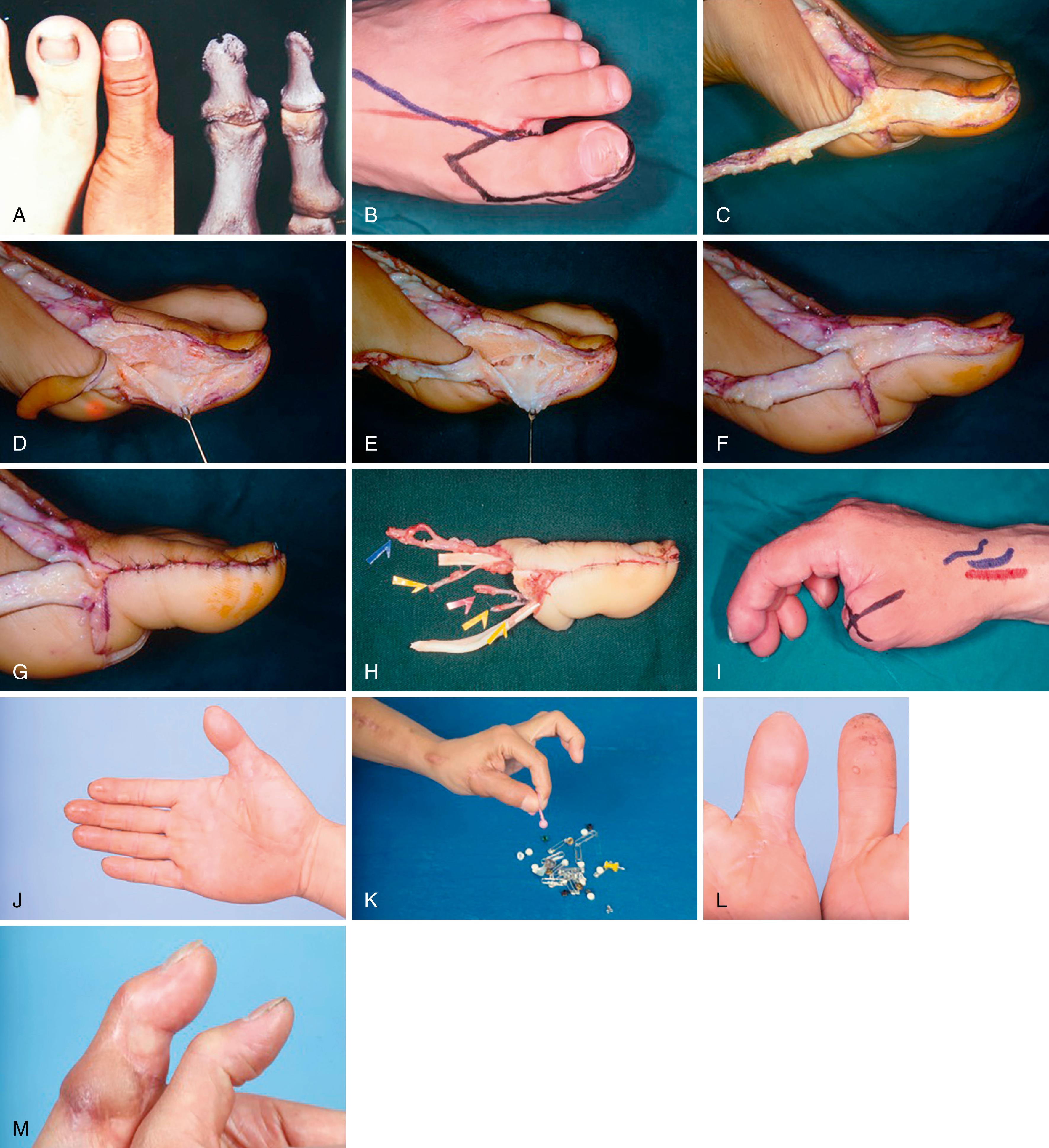 Fig. 47.12, A, Size discrepancy between a great toe and a thumb. B, Design of the skin incision. C-E, Trimming of soft tissue and longitudinal osteotomy through the proximal and distal phalanx, including the interphalangeal (IP) joint. F and G, Tight closure of the perijoint flap and skin. H, Harvested trimmed great toe. I, Preparation of the amputation stump through a cross-incision creating four flaps. J-M, Appearance and function of a clinical case. Note preservation of 30 degrees of active range of motion in the trimmed IP joint.