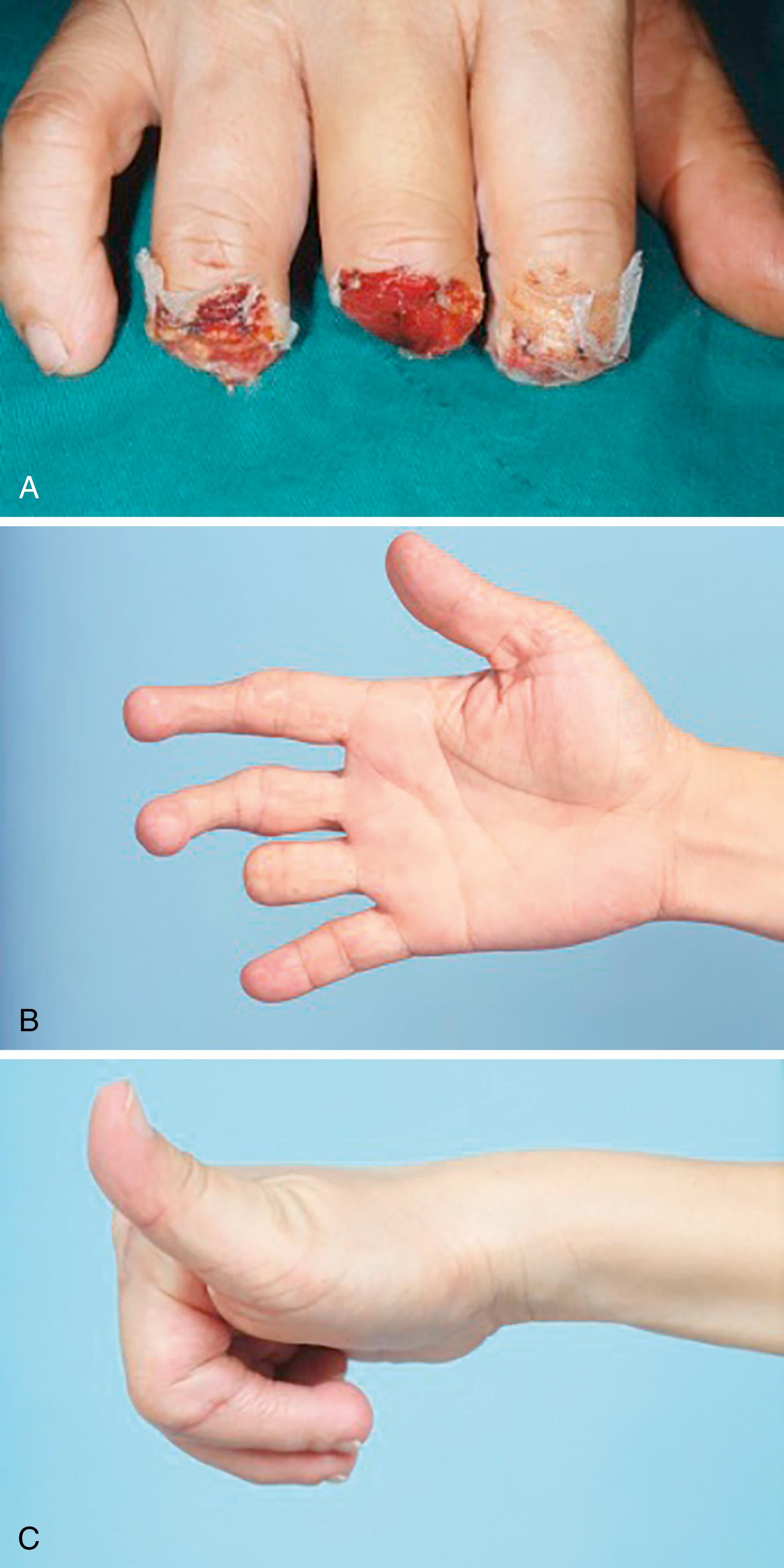 Fig. 47.2, A, Amputation of the index, middle, and ring fingers 7 days after debridement in a patient who sustained a severe crushing injury. The finger stumps are prepared for primary reconstruction by toe transplantation. B and C, After using two second toes for index and middle finger reconstruction, full active extension and flexion are possible.