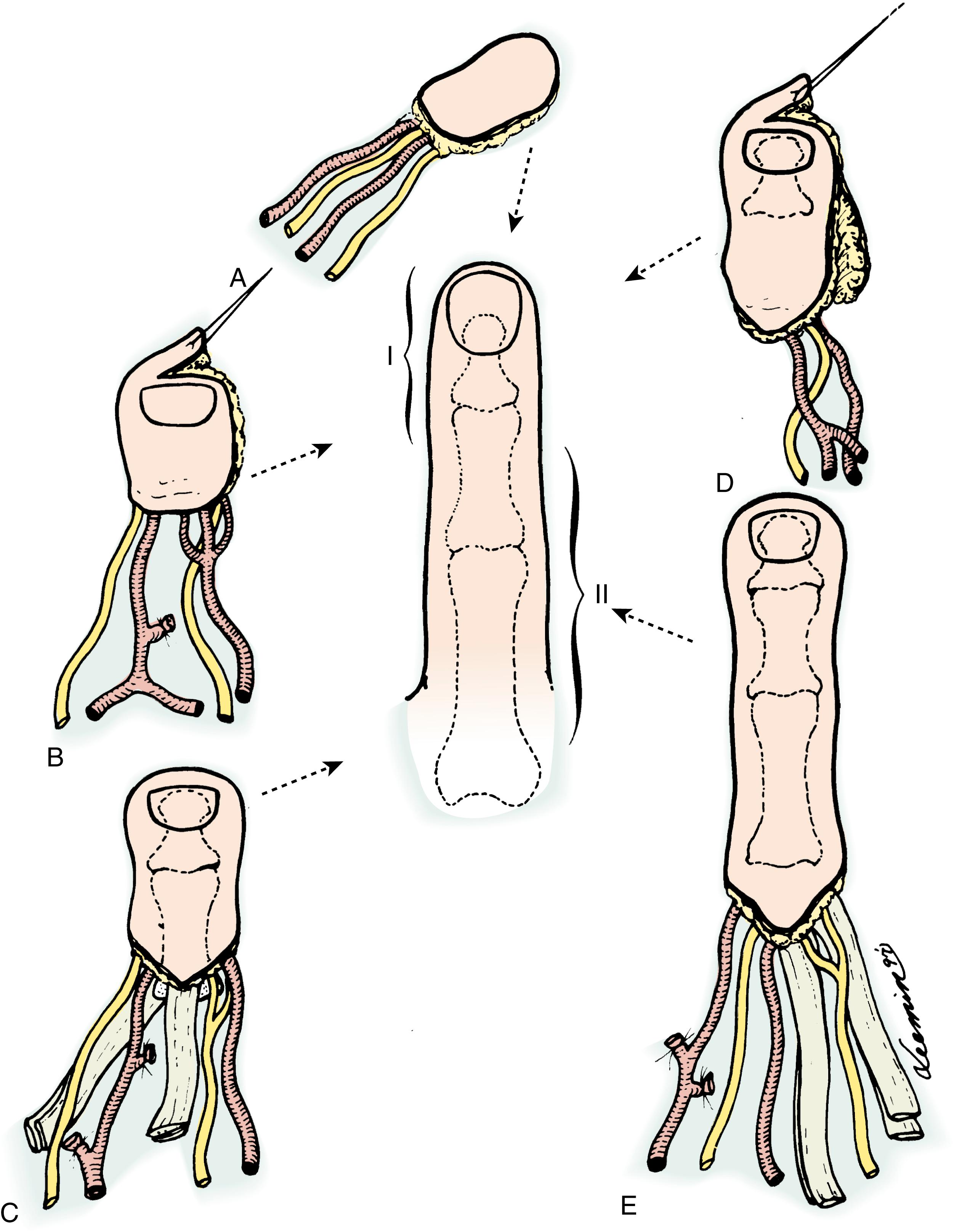 Fig. 47.3, Single-finger amputation levels and reconstructive options with toe-to-finger transplantation. A pulp toe flap (A) , vascularized nail graft (B) , partial lesser toe flap (C) , or wraparound lesser toe flap (D) can be used for distal finger amputation (I) . Total lesser toe transplantation (E) is used for proximal finger amputation (II) .