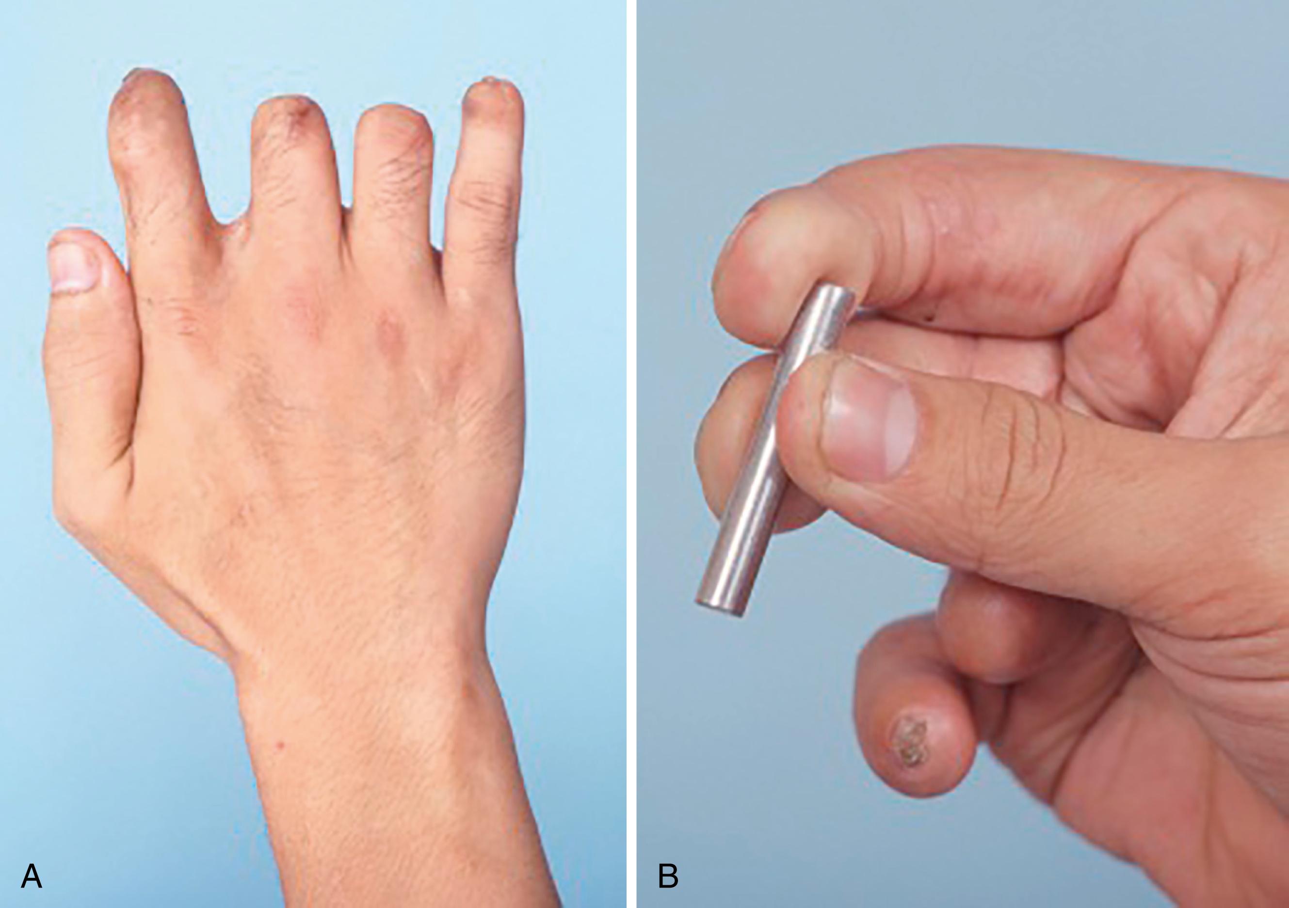 Fig. 47.4, A and B, With multiple-digit amputation, it is best to aim at reconstructing at least two adjacent fingers to provide useful tripod pinch, stronger hook grip, lateral stability, and handling precision.