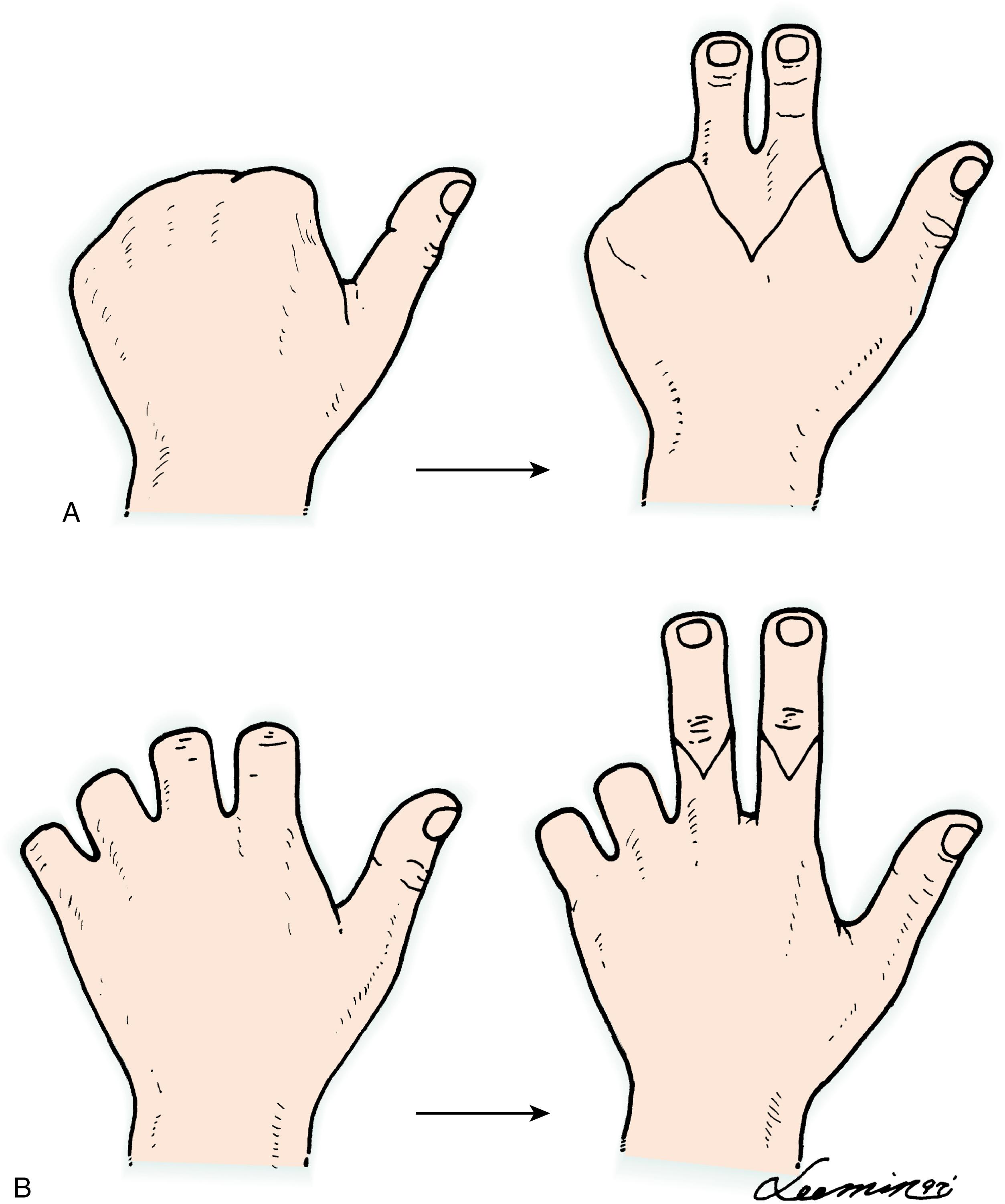 Fig. 47.5, In digit amputation proximal to the web spaces, combined second- and third-toe transplantation is advocated (A) , whereas in digit amputation distal to the web spaces, bilateral second-toe transplantation in one stage is preferable (B) .