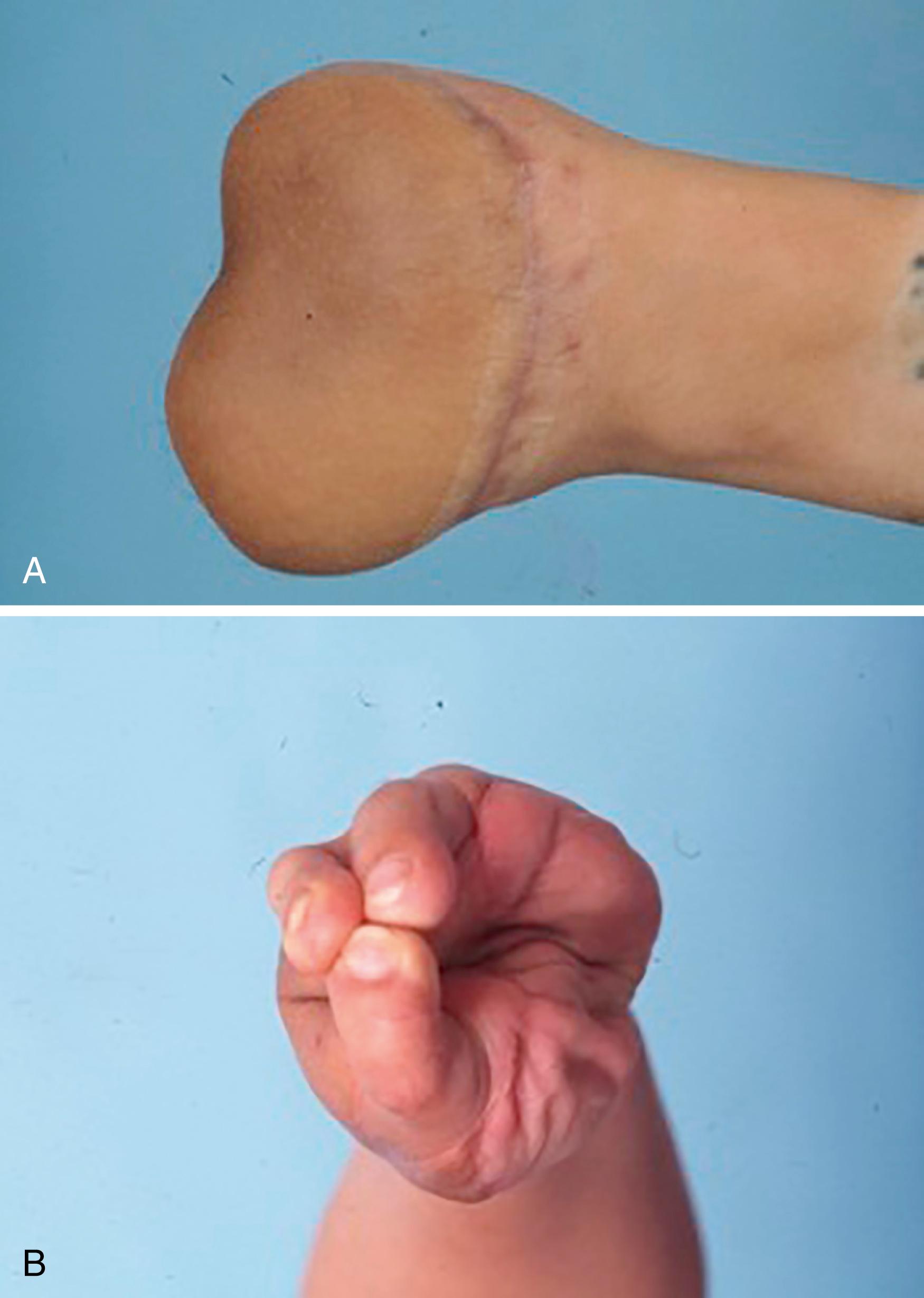 Fig. 47.6, A, Metacarpal hand subtype IIB: amputation of the thumb and all fingers proximal to the metacarpophalangeal joint with good thenar muscle function. B, Tripod pinch after reconstruction of the thumb by trimmed great-toe transplantation and reconstruction of the two radial fingers by combined transplantation of the second and third toes from the contralateral foot.