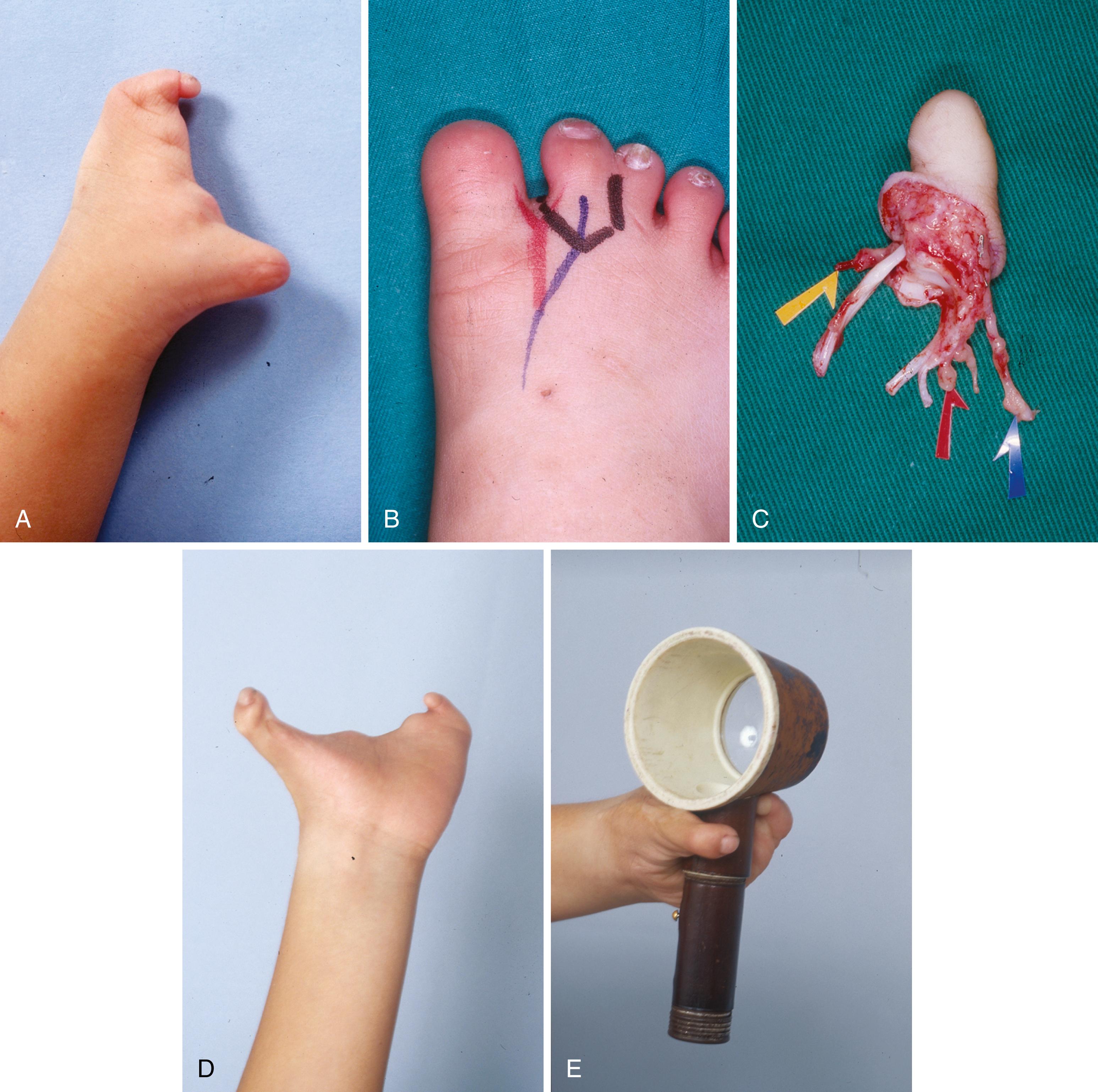 Fig. 47.9, A, Symbrachydactyly of the left hand in a 3-year-old boy. The patient has nearly complete absence of all digits of the hand with the exception of a rudimentary fifth finger. The thenar muscles are hypoplastic but maintain some function. B, The second toe was transferred from the right foot, which required concurrent release of syndactyly. (There was a congenital absence of toes on the left foot, necessitating use of the right foot as the donor.) C, The harvested toe based on the first dorsal metatarsal artery. The upper arrow indicates the vein, the middle arrow the artery, and the lower arrow the nerve. D and E, Ten years after the procedure the patient demonstrates good function. Although he cannot achieve pulp-to-pulp pinch owing to thenar hypoplasia and poor interphalangeal joint motion, he has excellent span and a useful grip.