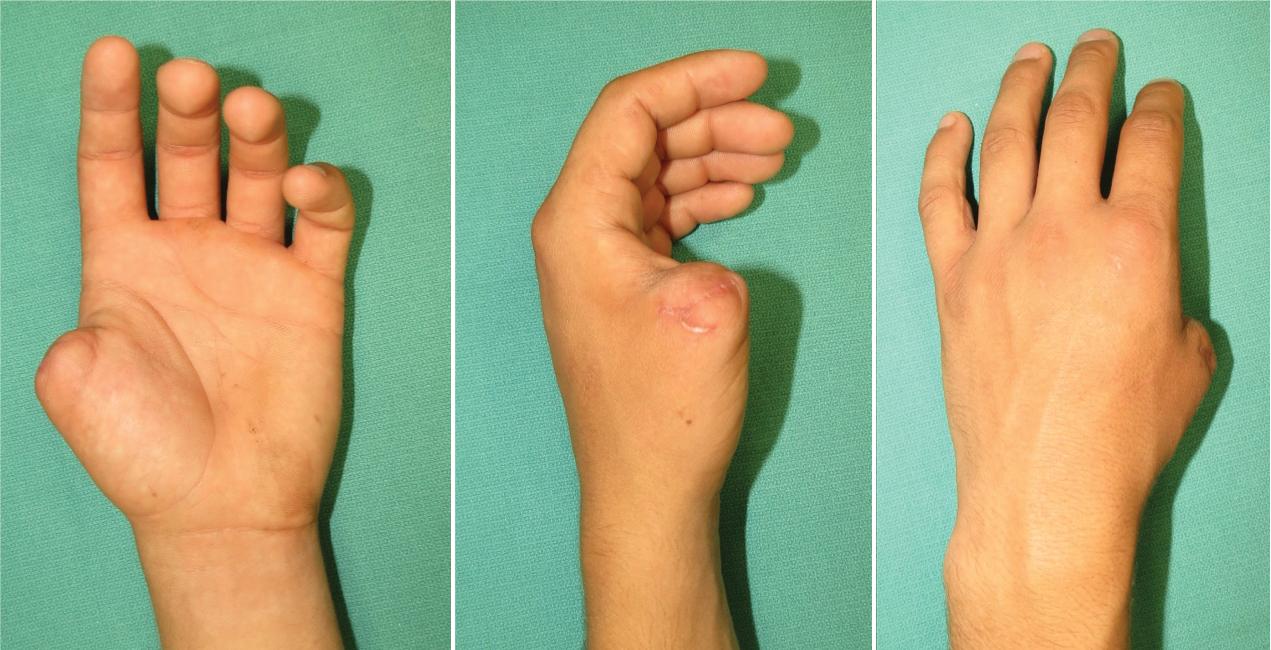 FIGURE 95.1, Traumatic thumb amputation at the level of MCP joint. MCP , Metacarpophalangeal.