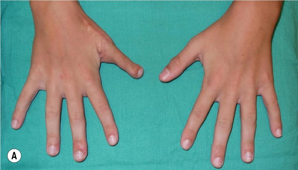 FIGURE 95.2, (A) A 4.5-year follow-up after transfer of the second toe to the right thumb. (B) Appearance of the donor site.