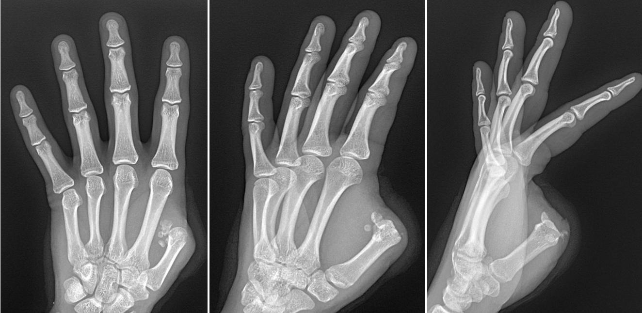 FIGURE 95.3, Radiographs show a thumb amputation at the level of the MCP joint. MCP, Metacarpophalangeal.