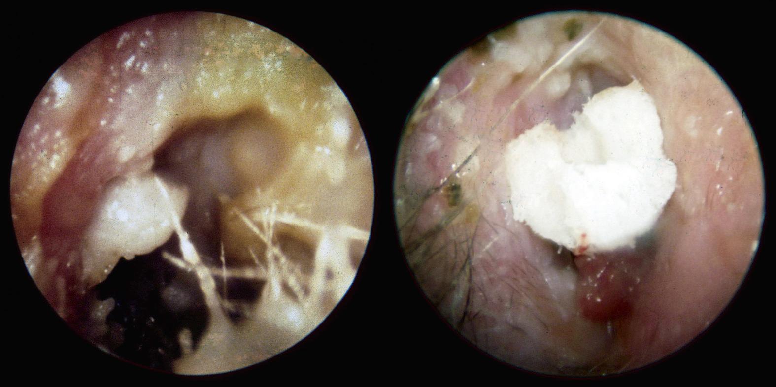 Fig. 139.1, Acute otitis externa.