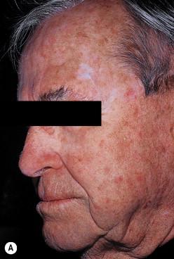 Figure 43.2, Male with multiple actinic keratoses treated with 0.5% 5-FU q.d. A) Pre-treatment. B) After 2 weeks. C) Post-treatment.