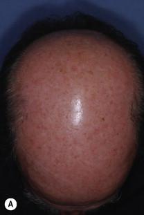 Figure 43.3, Patient with multiple actinic keratoses. Forehead and scalp treated with 3.75% imiquimod cream q.h.s. daily. A) Pre-treatment. B) Week 2, end of first treatment cycle. C) End of 2-week rest period D) Week 6, end of second cycle. E) Week 8, post-therapy.