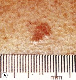 Figure 43.4, Treatment of sBCC with imiquimod 5% cream. A) Pre-treatment. B) Week 4, daily treatment. C) Week 6, post daily treatment.