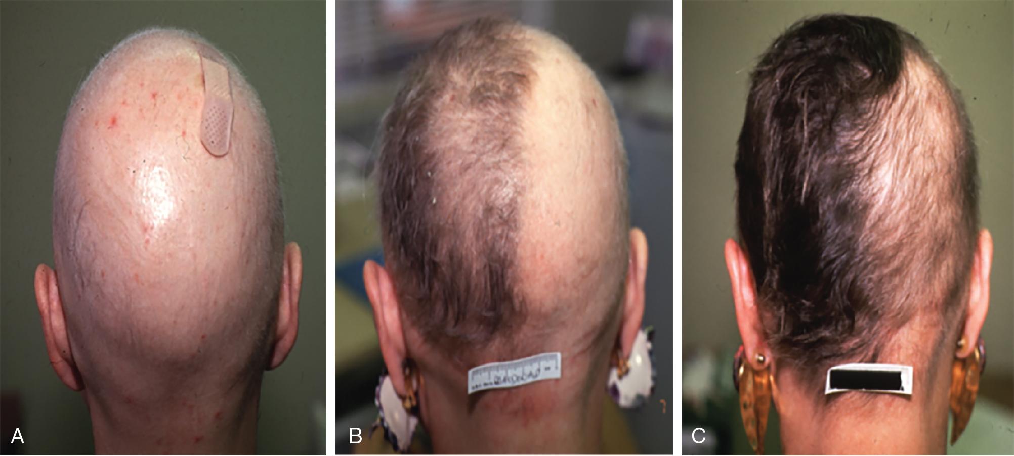 Fig. 9.1, (A) Patient with alopecia areata prior to treatment with topical immunotherapy. (B) Four months after treatment of alopecia areata with topical immunotherapy. (C) Seven months after treatment of alopecia areata with topical immunotherapy.