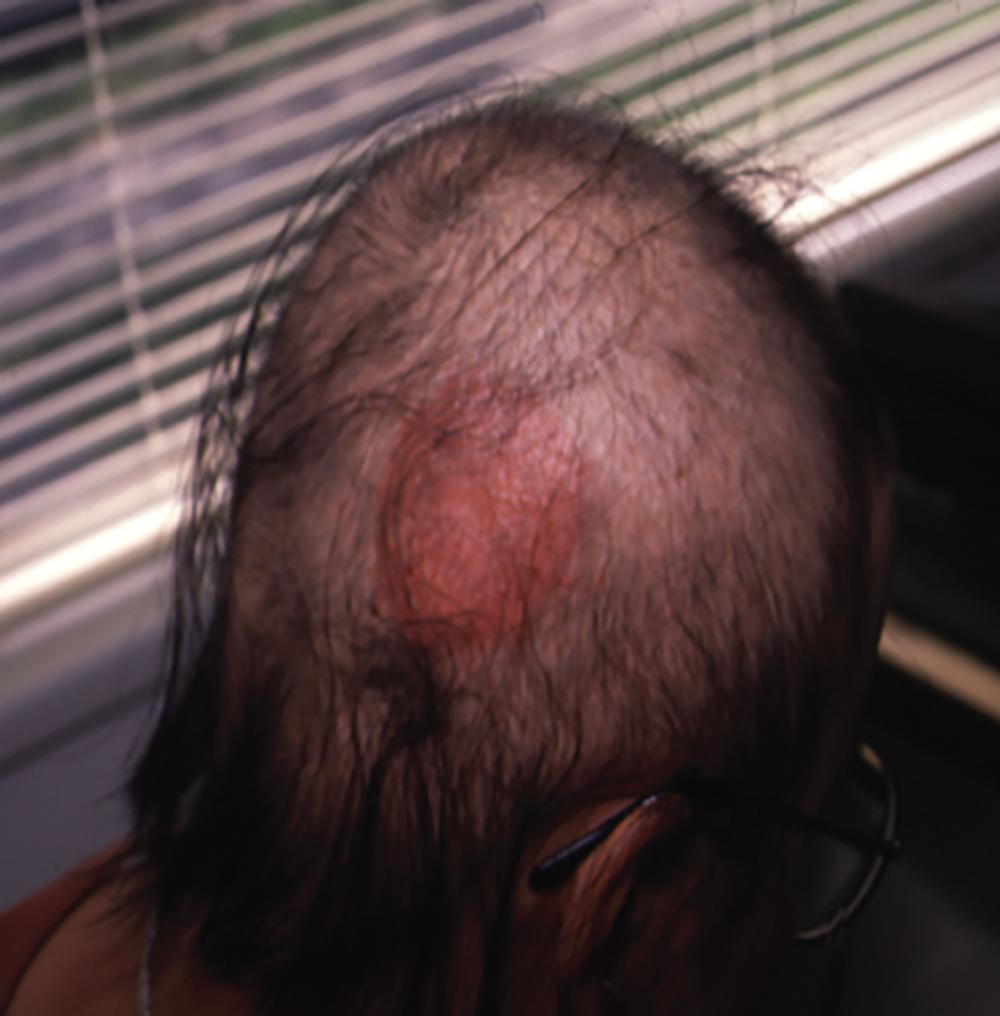 Fig. 9.2, Approximately 2 weeks after sensitization of the scalp with a 2% solution of diphenylcyclopropenone (DPCP) or squaric acid dibutylester (SADBE), an allergic contact dermatitis should appear.