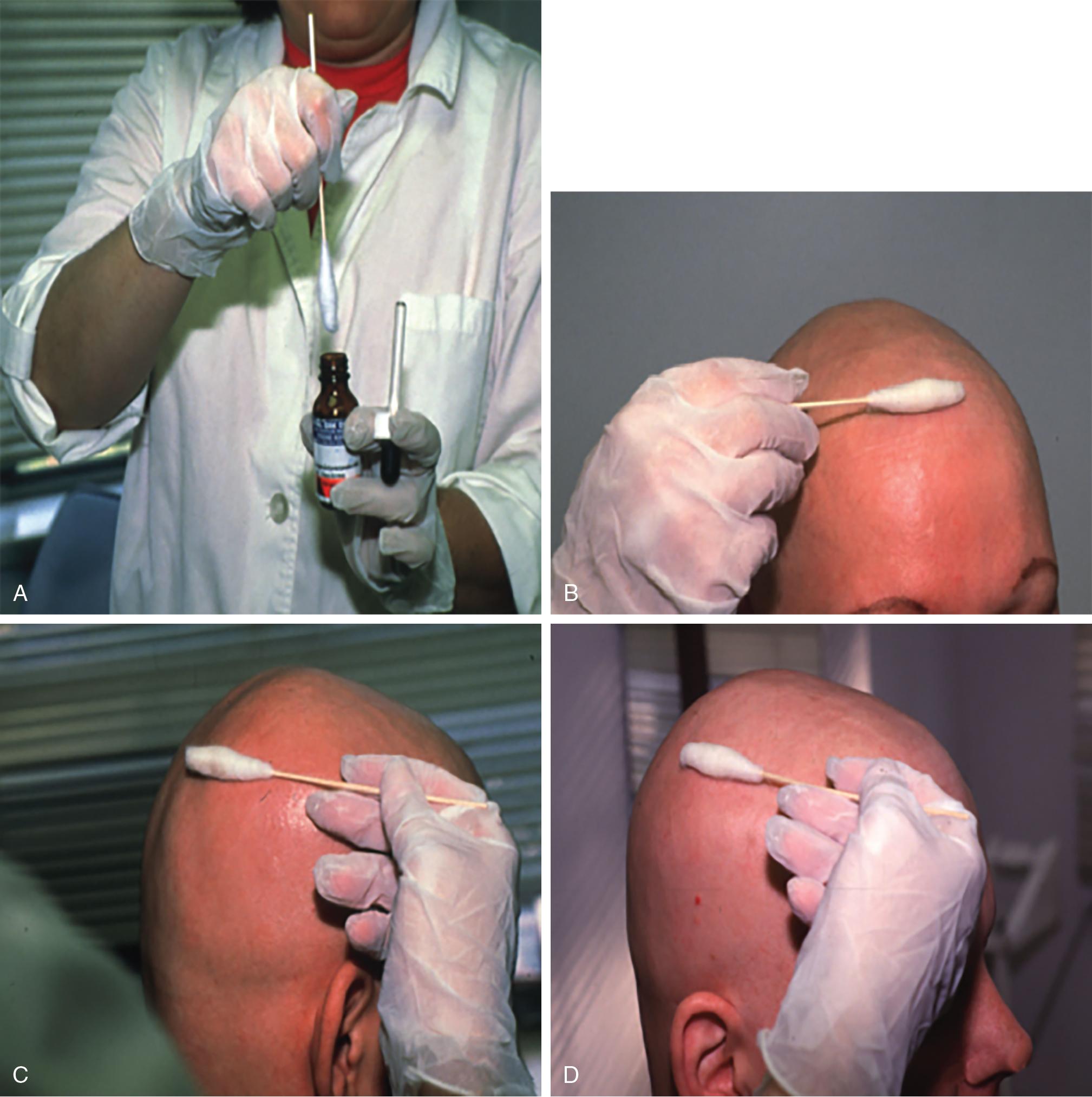 Fig. 9.3, (A-D) A cotton-reinforced applicator is used to apply topical immunotherapy to alopecic areas. For treatment of the scalp, the solution is applied antero posteriorly and then laterally. Proper personal protective equipment, including gloves, should be worn by the provider, family member, or patient who is applying the immunotherapy. Care should be taken to avoid spills, which can cause severe allergic reactions.