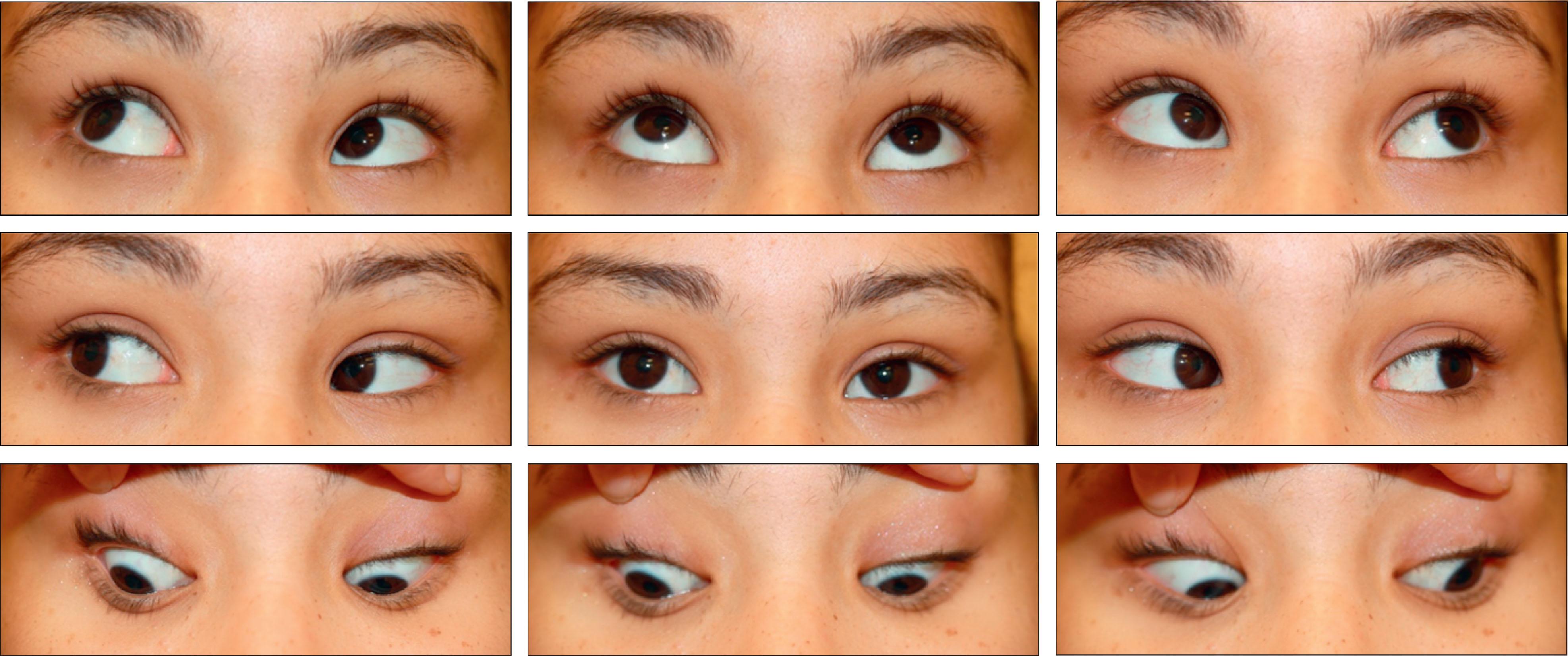 Fig. 11.8.1, Nine-gaze ocular photograph displaying A pattern with superior oblique overaction as a result of incyclotorsion.