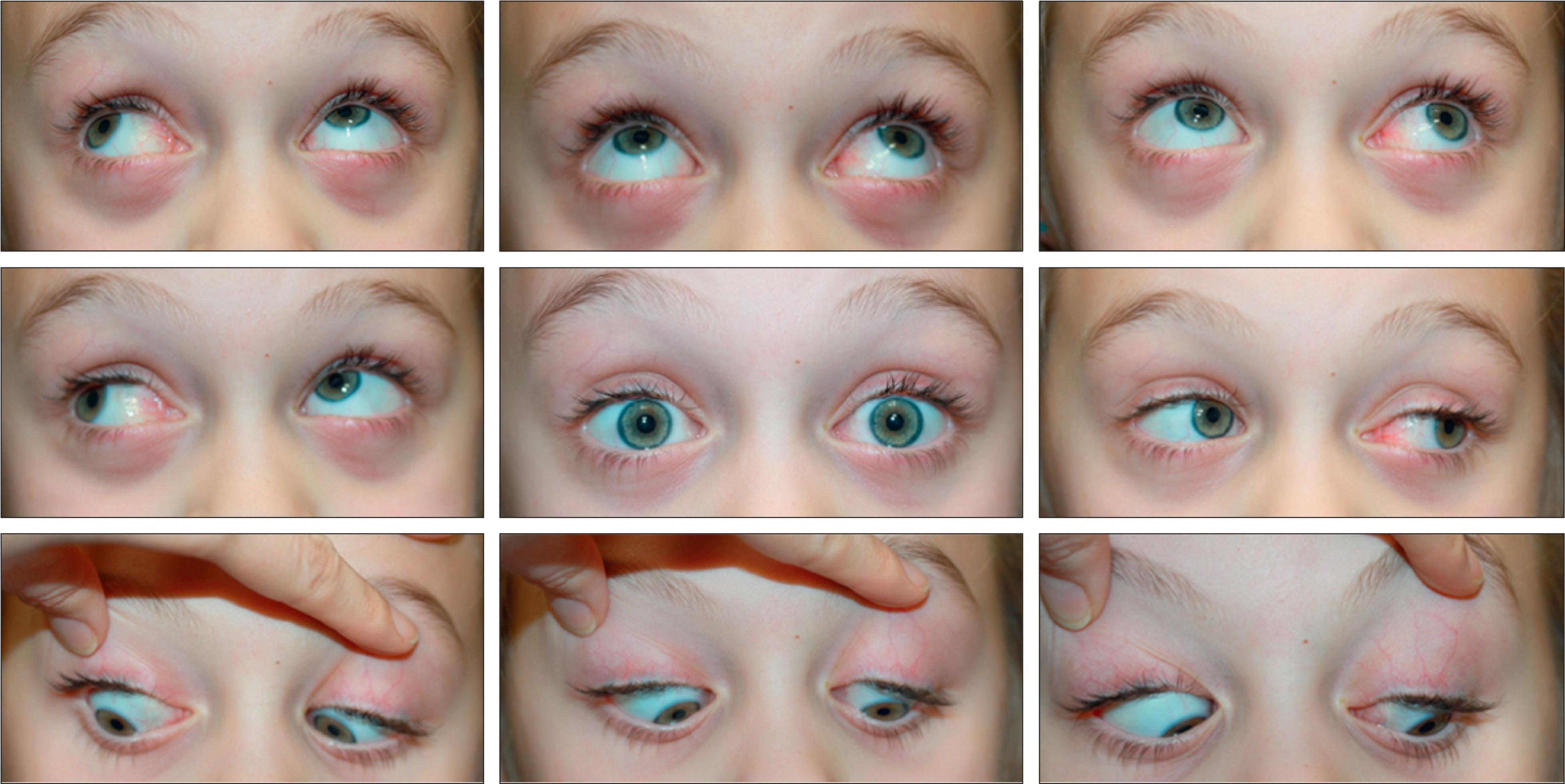 Fig. 11.8.2, Nine-gaze ocular photograph displaying V pattern with inferior oblique overaction and superior oblique underaction in a patient with excyclotorsion.