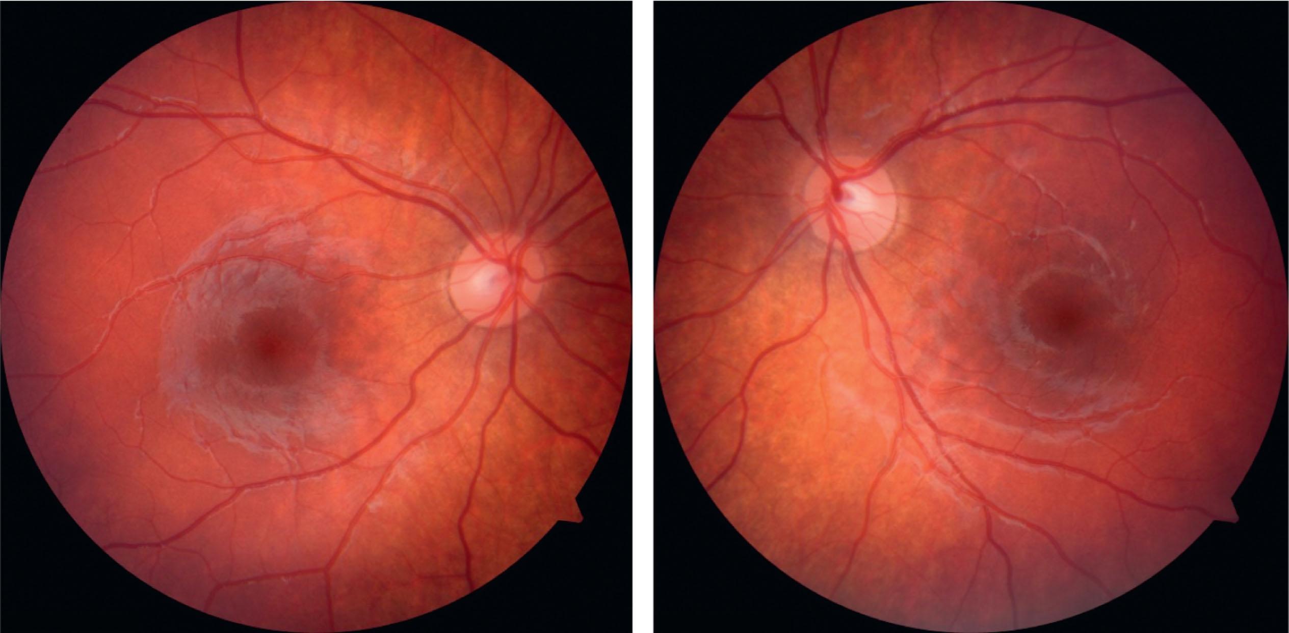 Fig. 11.8.3, Ocular fundus photographs of both eyes, displaying bilateral excyclotorsion.