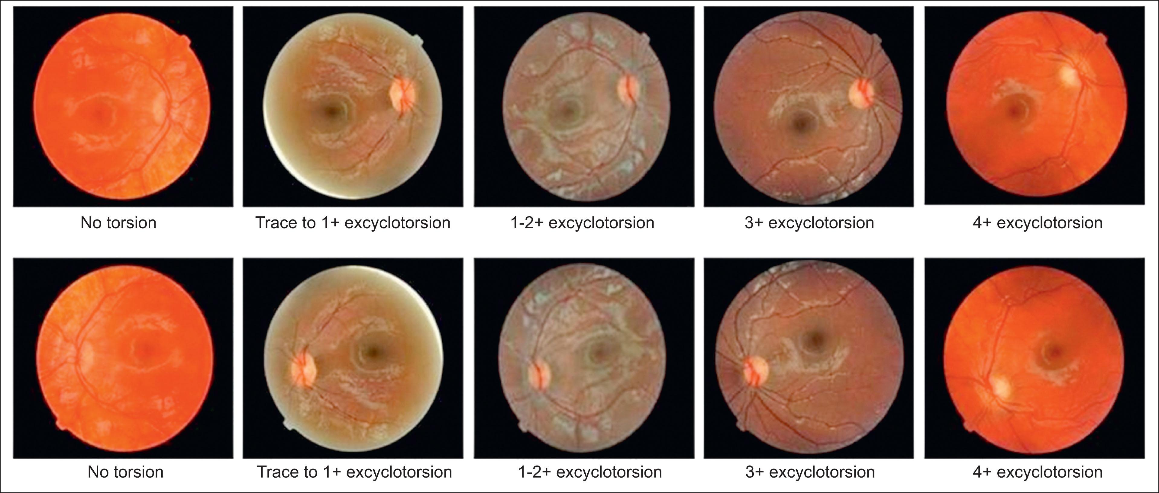 Fig. 11.8.4, Ocular fundus photographs displaying five grades of excyclotorsion, progressing from none to 4+. The top row displays fundus photographs of the direct view of anatomical torsion. Below each photograph, the image is inverted to illustrate the view seen by the examiner when using indirect ophthalmoscopy.