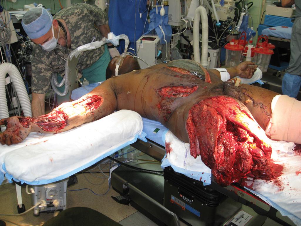 FIGURE 2, Injuries sustained by the passenger in a military vehicle struck by an improvised explosive device, including mangled/amputated extremities, penetrating hollow viscus injuries, pelvic fracture, brachial artery laceration, and pulmonary contusions.